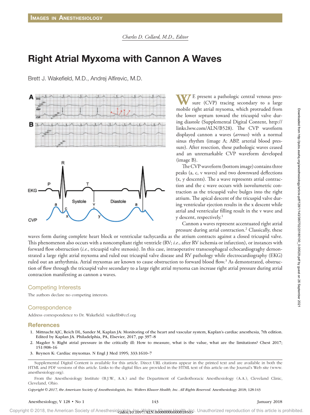 Right Atrial Myxoma with Cannon a Waves