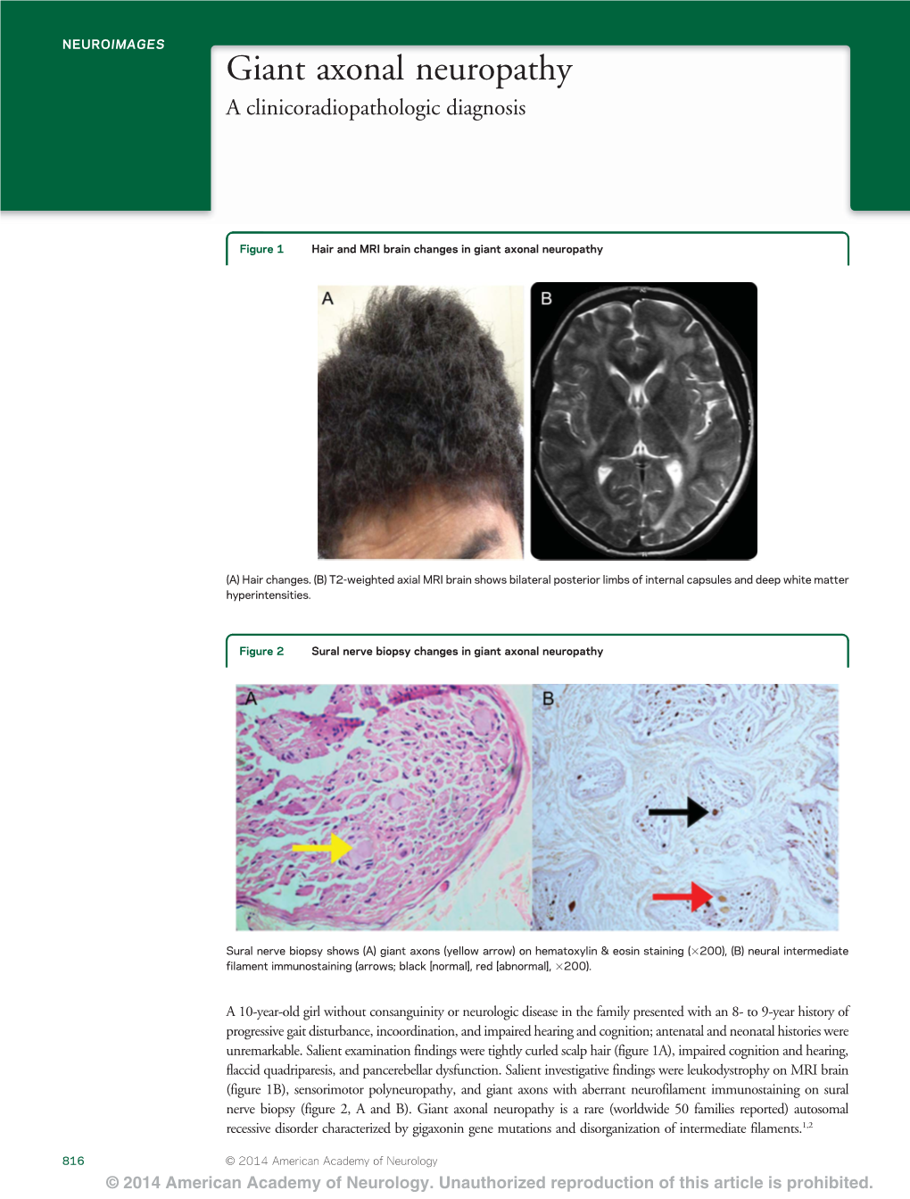 Giant Axonal Neuropathy a Clinicoradiopathologic Diagnosis