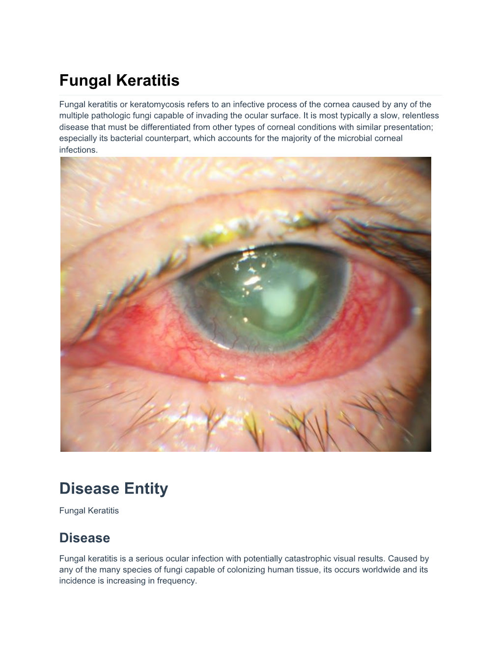 Fungal Keratitis