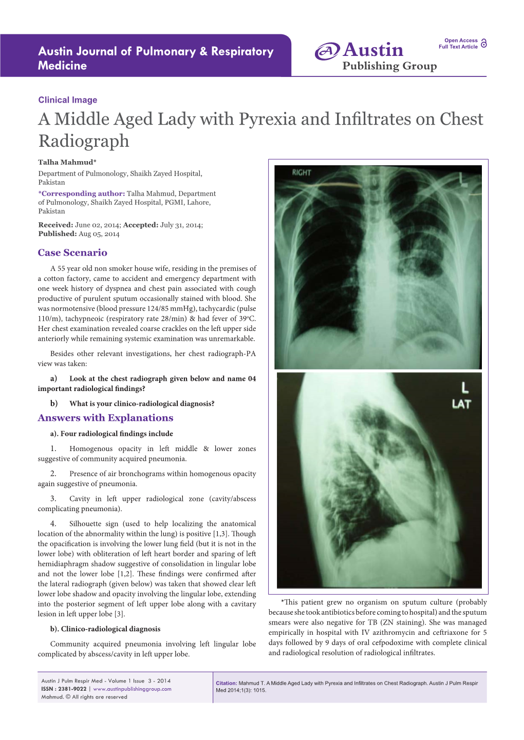 A Middle Aged Lady with Pyrexia and Infiltrates on Chest Radiograph