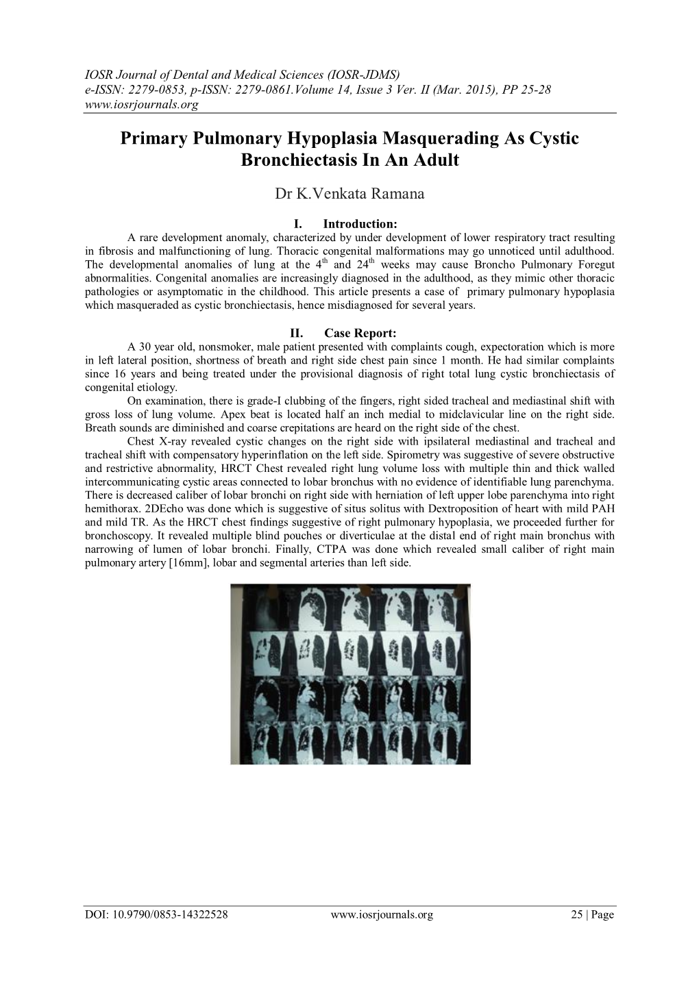 Primary Pulmonary Hypoplasia Masquerading As Cystic Bronchiectasis in an Adult