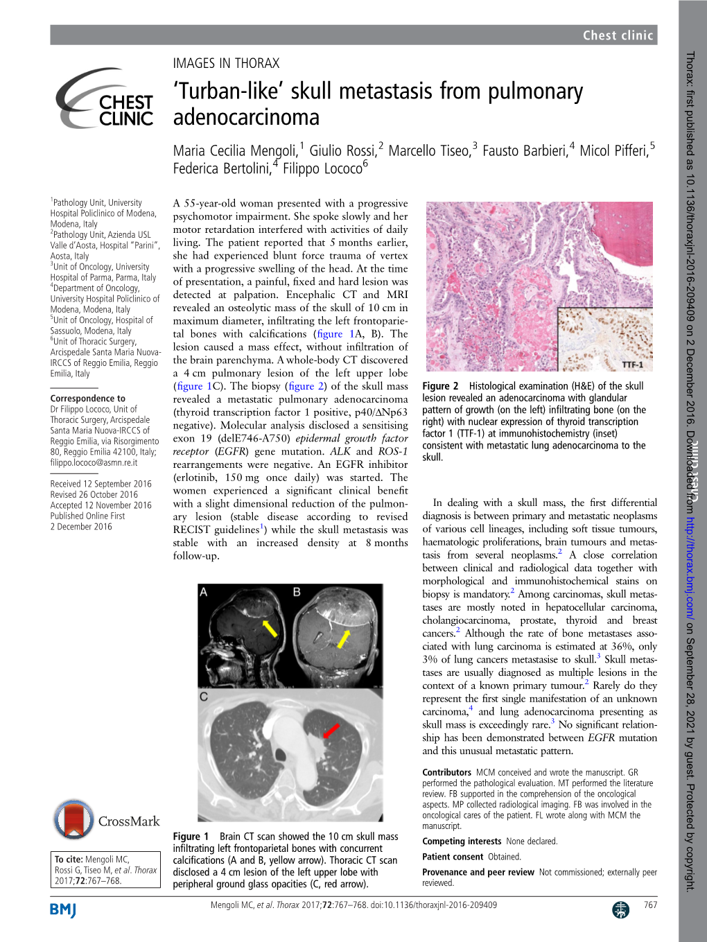 'Turban-Like' Skull Metastasis from Pulmonary Adenocarcinoma