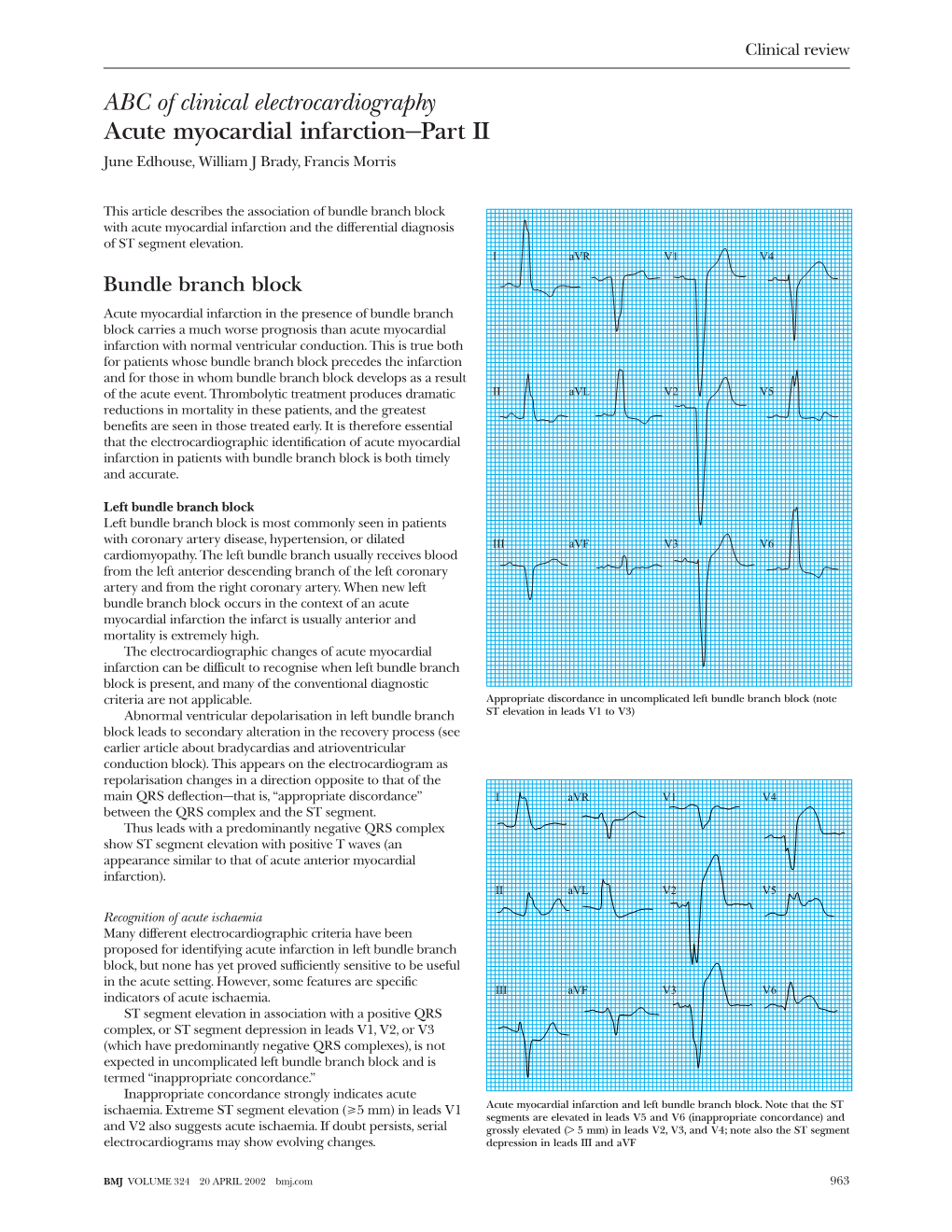 ABC of Clinical Electrocardiography Acute Myocardial Infarction—Part II June Edhouse, William J Brady, Francis Morris