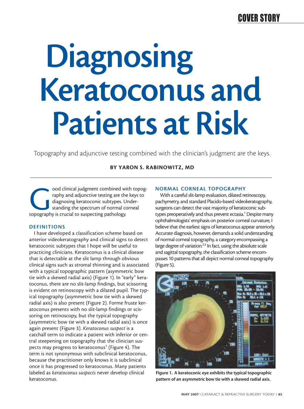 Diagnosing Keratoconus and Patients at Risk