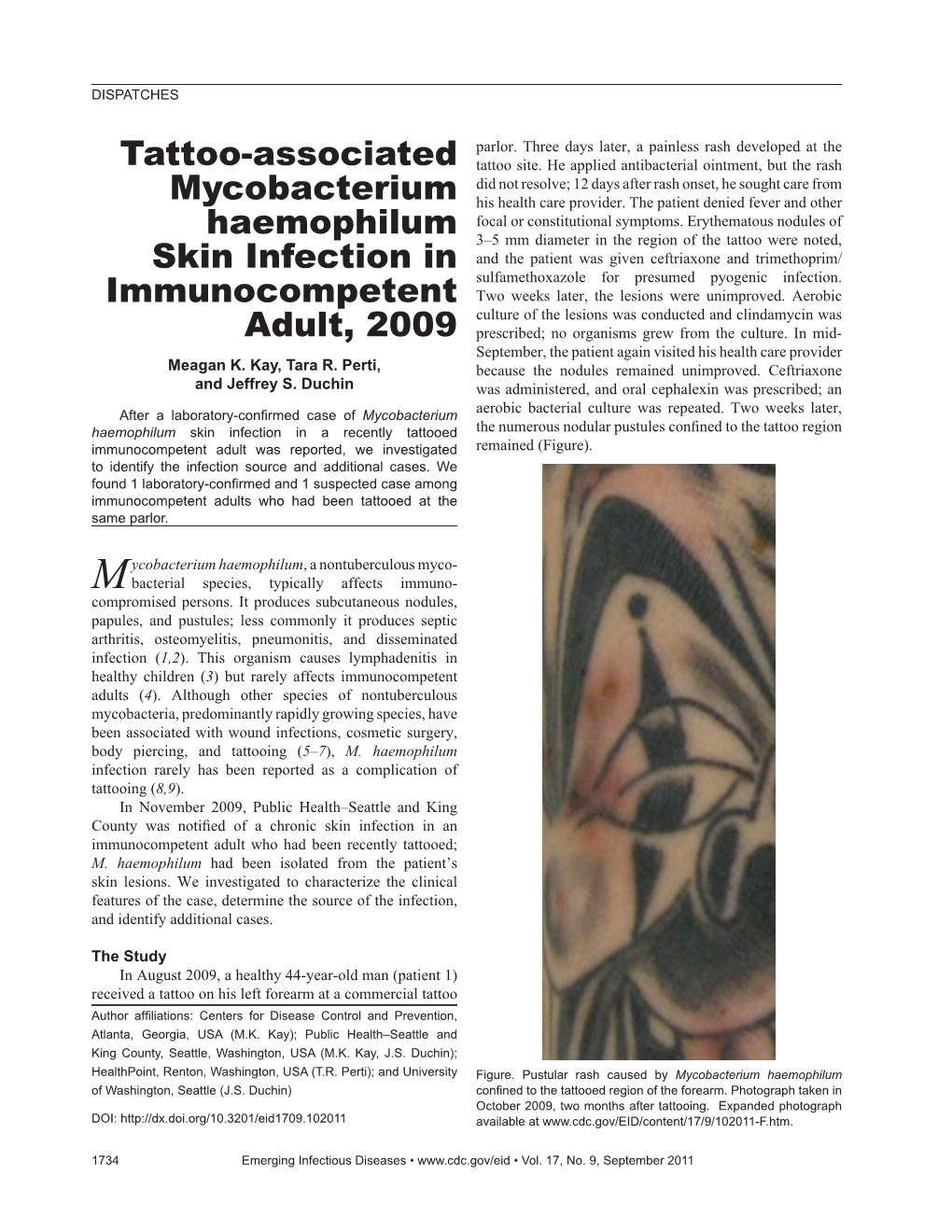 Tattoo-Associated Mycobacterium Haemophilum Skin Infection