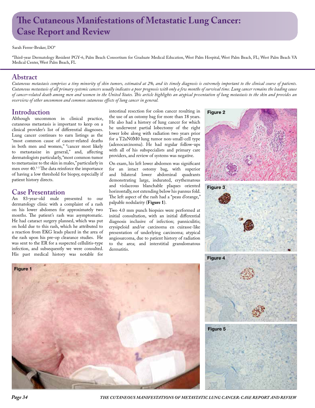 The Cutaneous Manifestations of Metastatic Lung Cancer: Case Report and Review