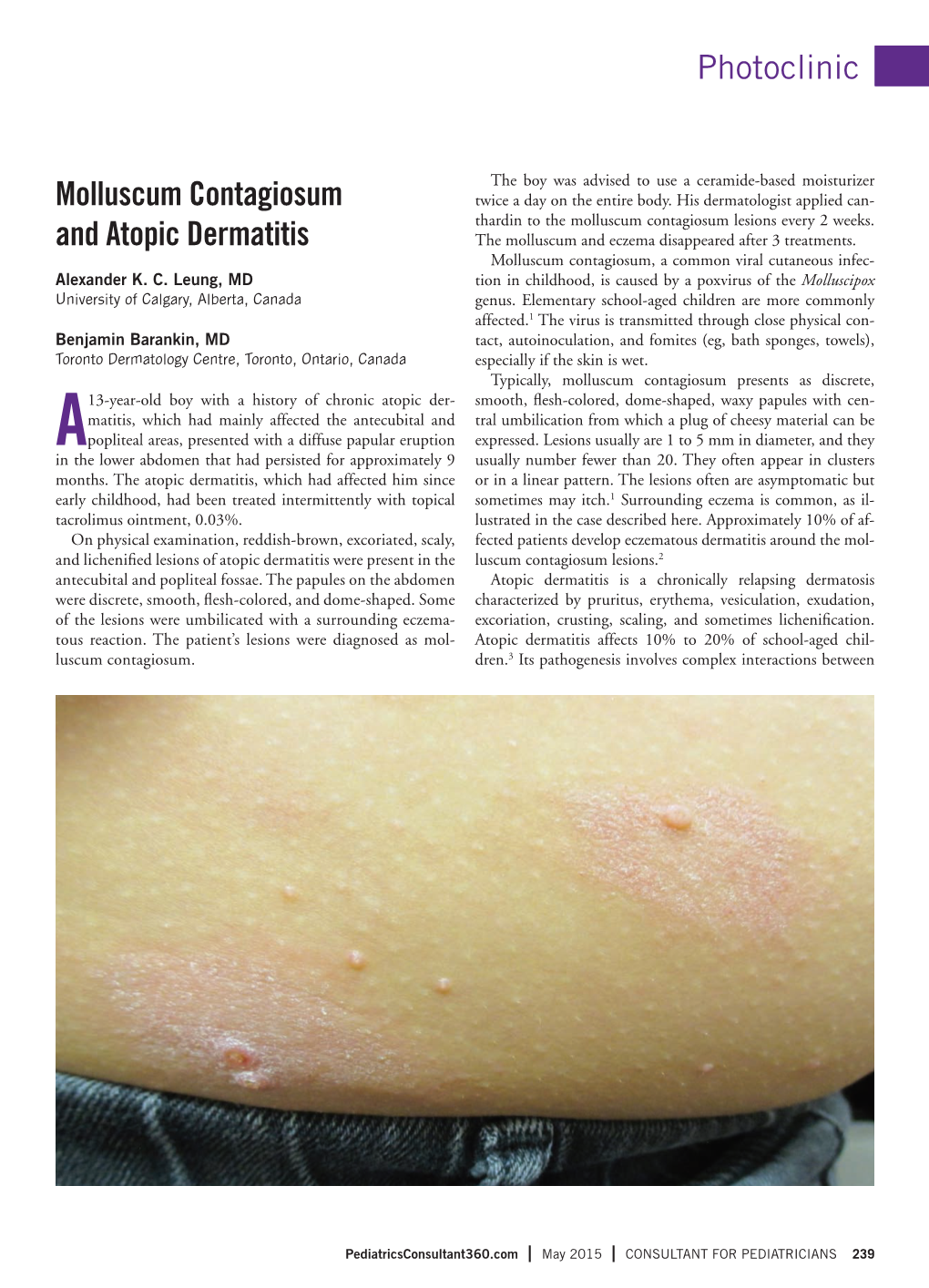 Molluscum Contagiosum & Atopic Dermatitis