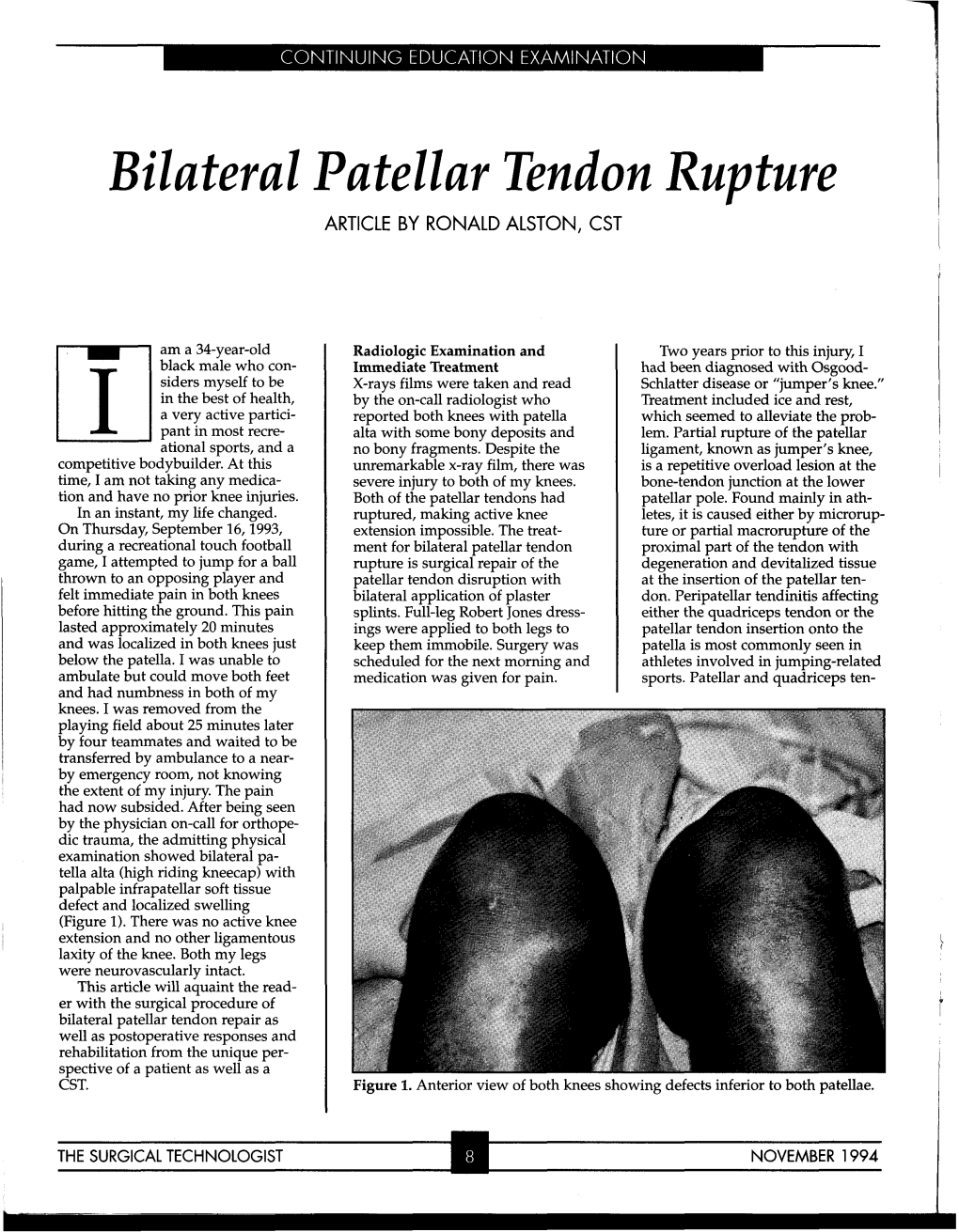 Bilateral Patellar Tendon Rupture ARTICLE by RONALD ALSTON, CST