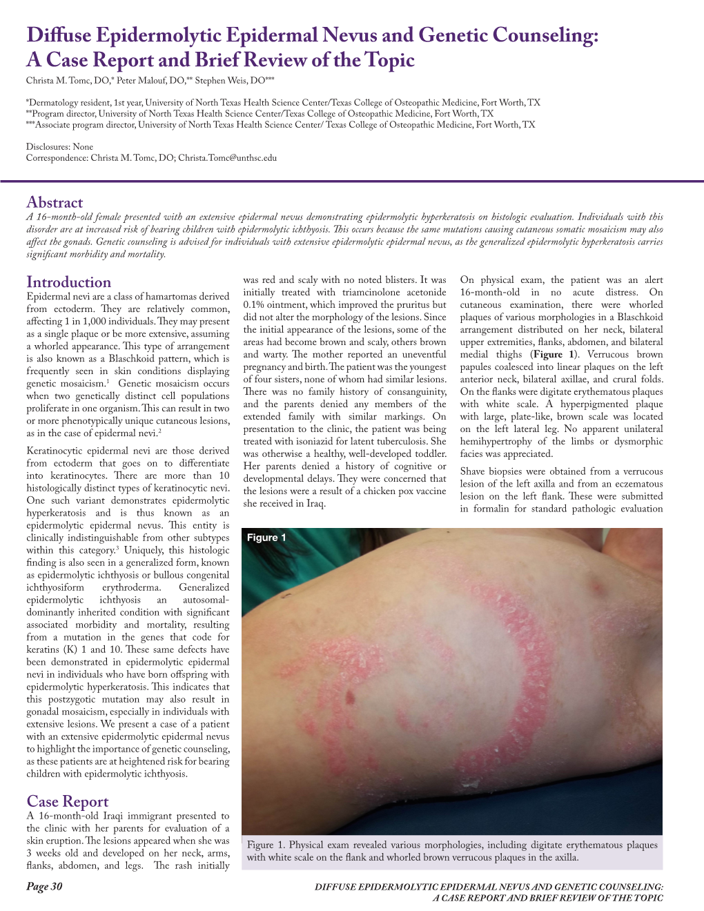 Diffuse Epidermolytic Epidermal Nevus and Genetic Counseling: a Case Report and Brief Review of the Topic Christa M