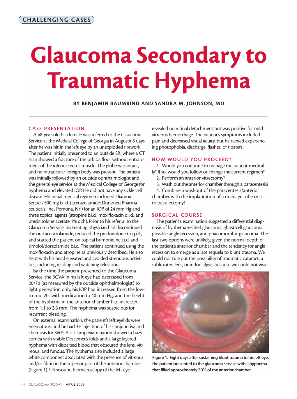 Glaucoma Secondary to Traumatic Hyphema