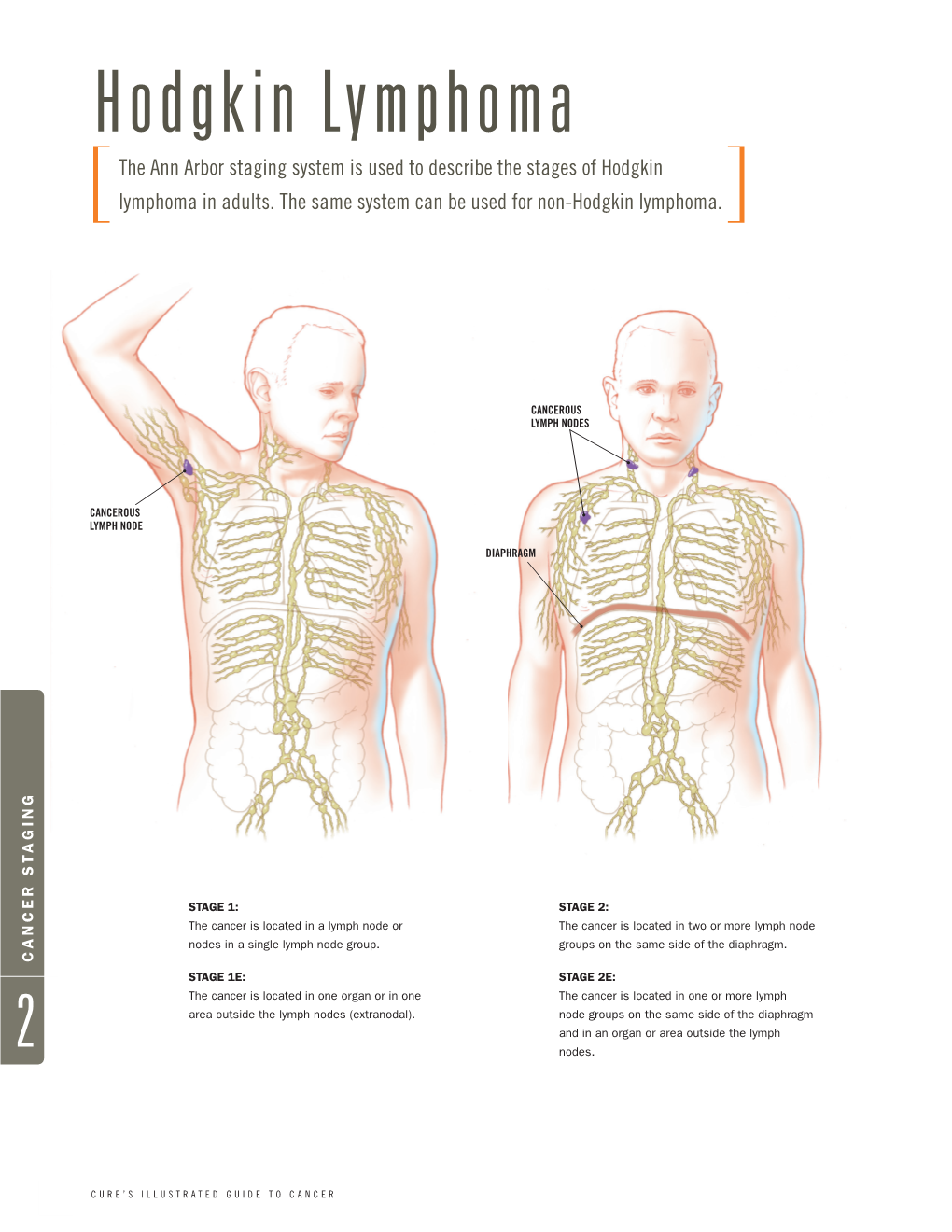 Hodgkin Lymphoma the Ann Arbor Staging System Is Used to Describe the Stages of Hodgkin [Lymphoma in Adults