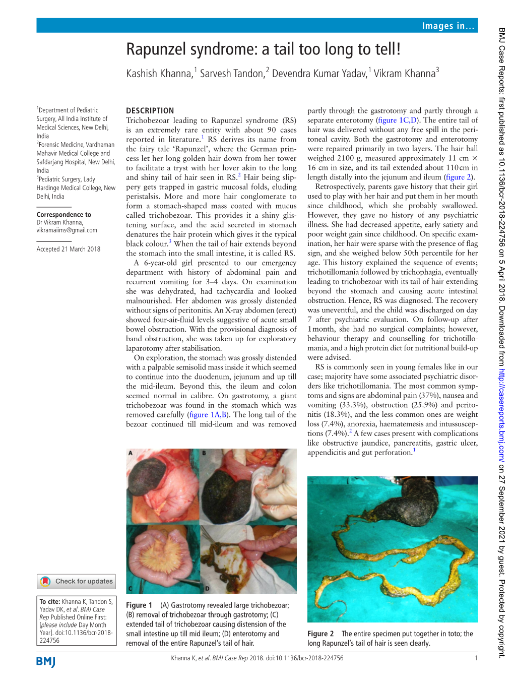 Rapunzel Syndrome: a Tail Too Long to Tell! Kashish Khanna,1 Sarvesh Tandon,2 Devendra Kumar Yadav,1 Vikram Khanna3