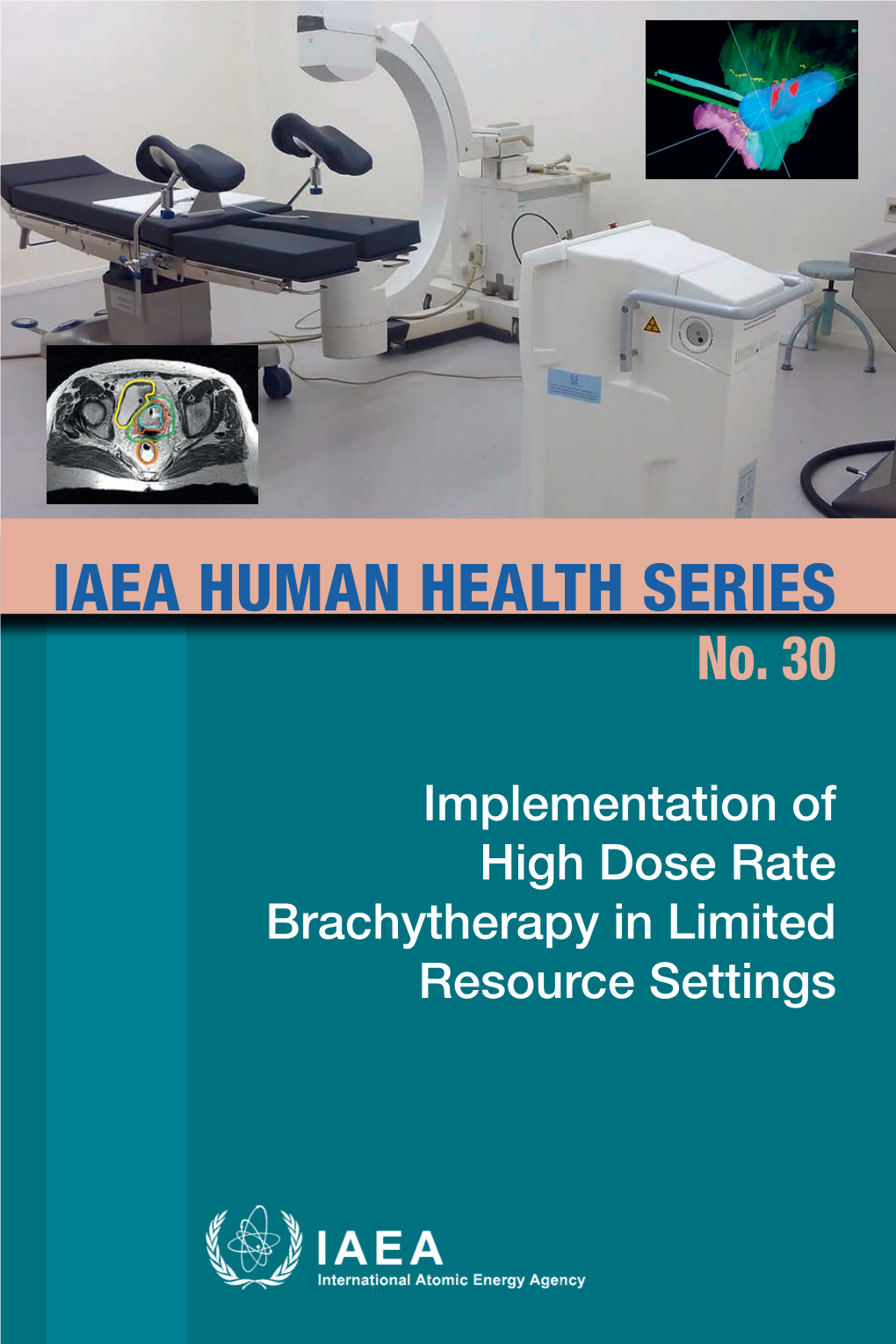 Implementation of High Dose Rate Brachytherapy in Limited Resource Settings No