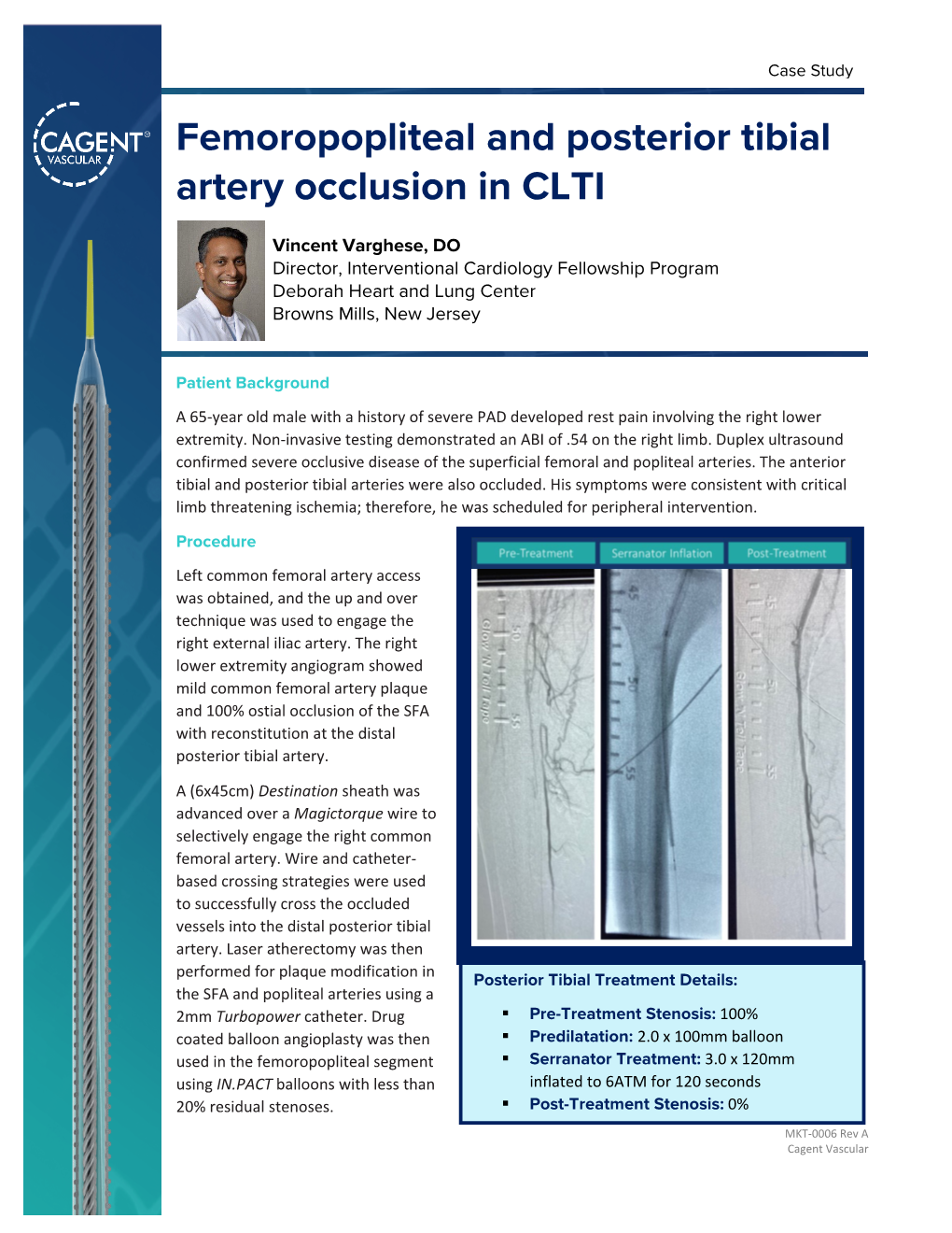 Femoropopliteal and Posterior Tibial Artery Occlusion in CLTI