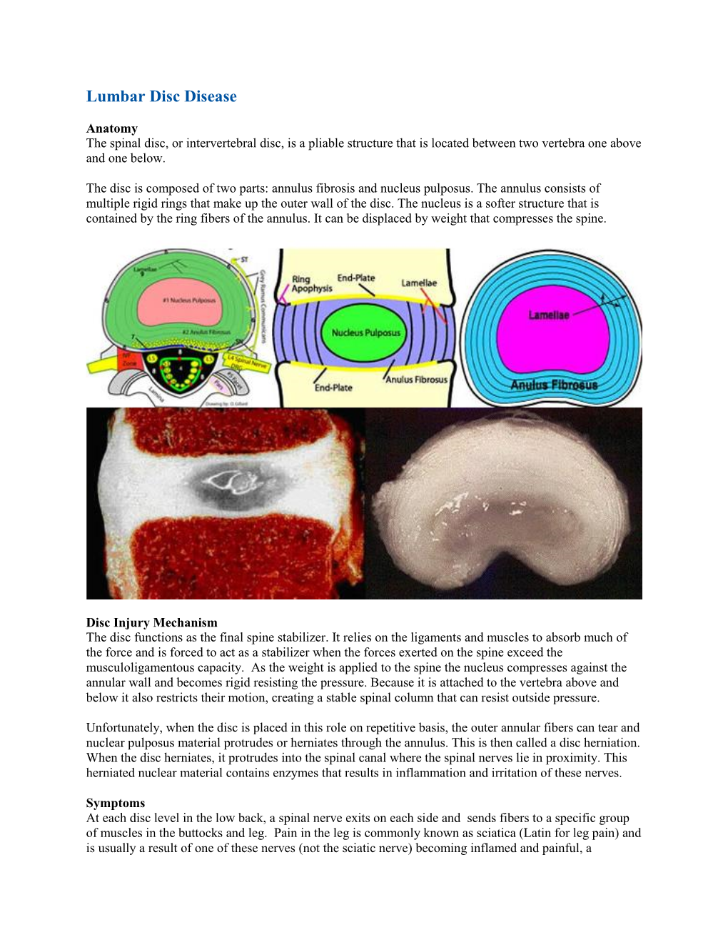 Lumbar Disc Disease