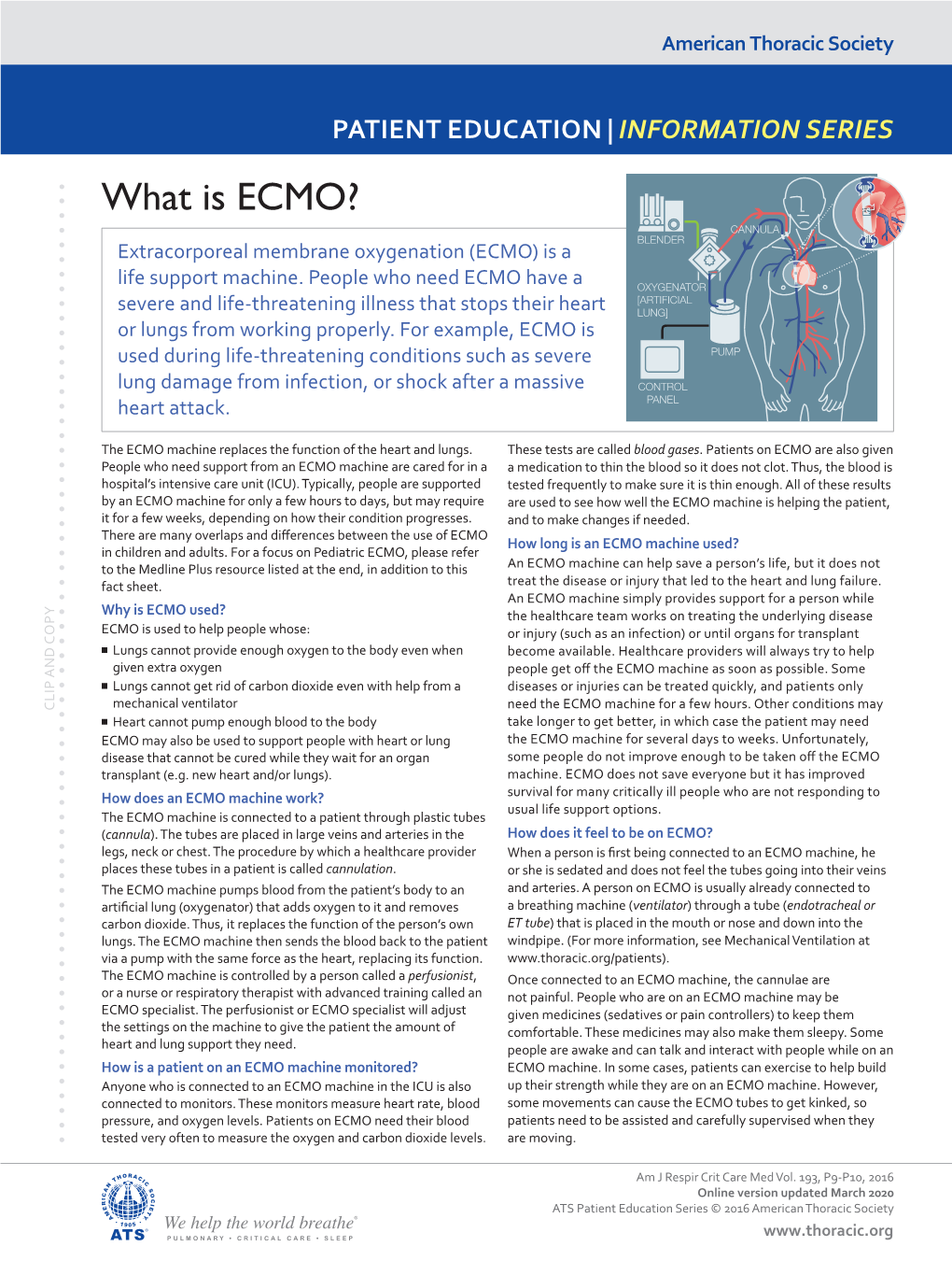 What Is ECMO? CANNULA BLENDER Extracorporeal Membrane Oxygenation (ECMO) Is A