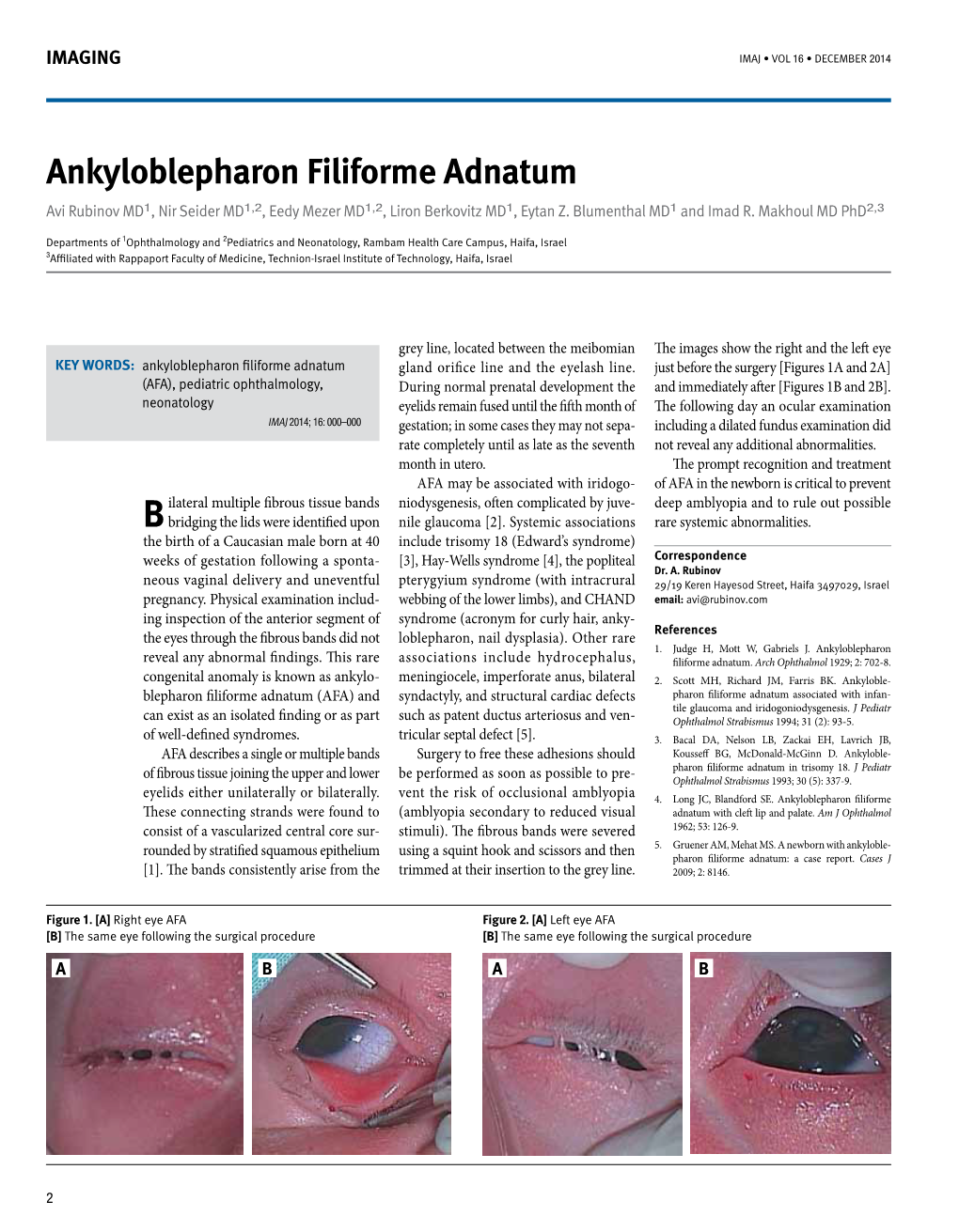 Ankyloblepharon Filiforme Adnatum Avi Rubinov MD1, Nir Seider MD1,2, Eedy Mezer MD1,2, Liron Berkovitz MD1, Eytan Z