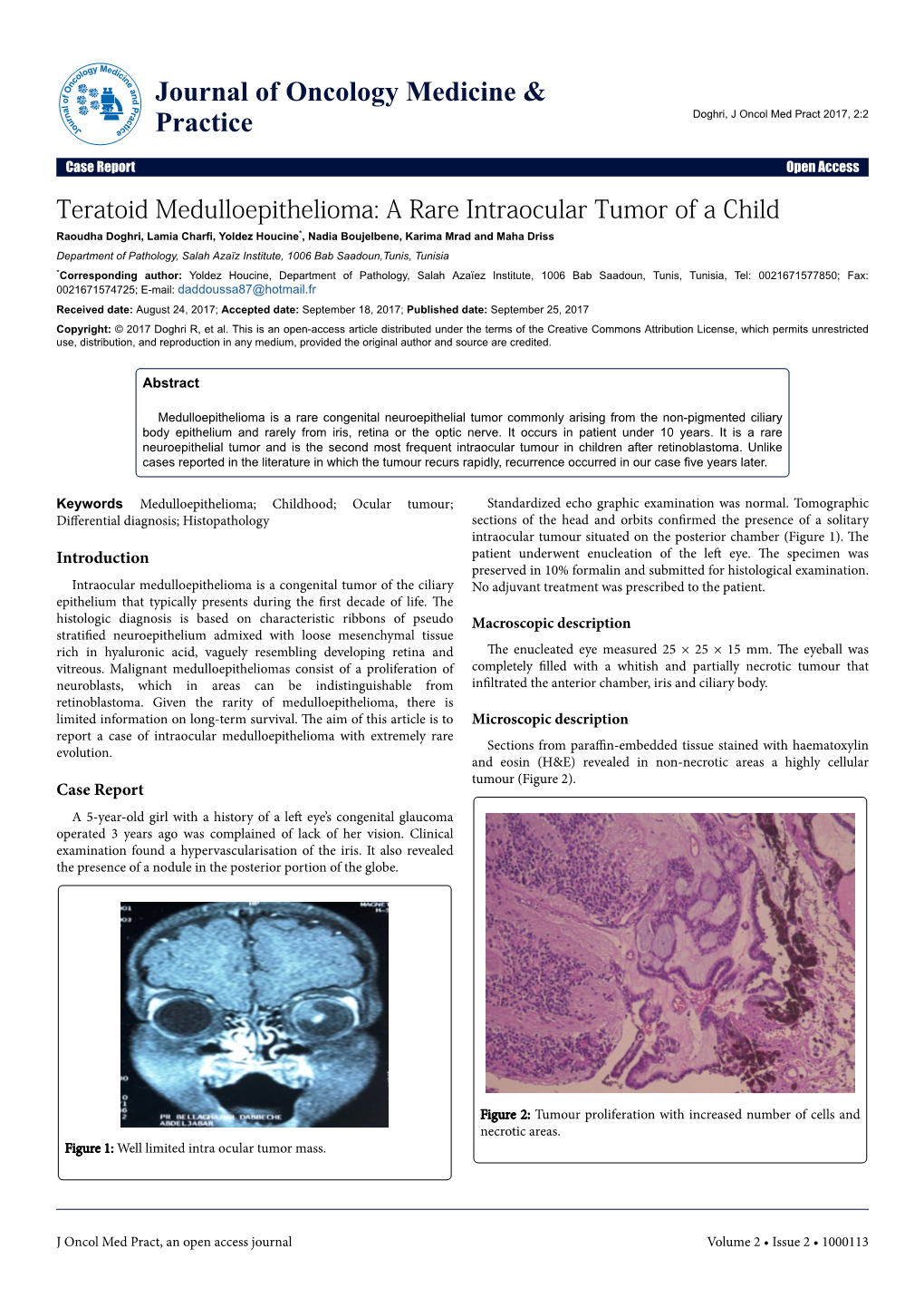 Teratoid Medulloepithelioma: a Rare Intraocular Tumor of a Child