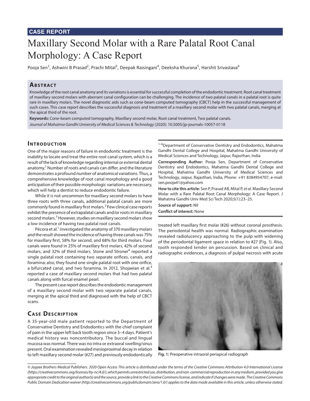 Maxillary Second Molar with a Rare Palatal Root Canal Morphology: A
