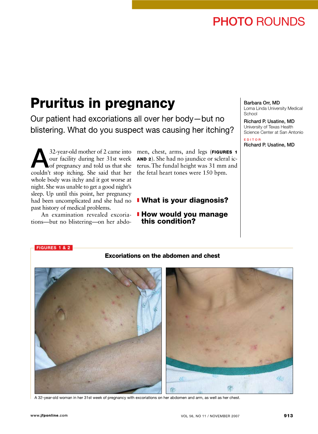 Pruritus in Pregnancy Loma Linda University Medical School Our Patient Had Excoriations All Over Her Body—But No Richard P