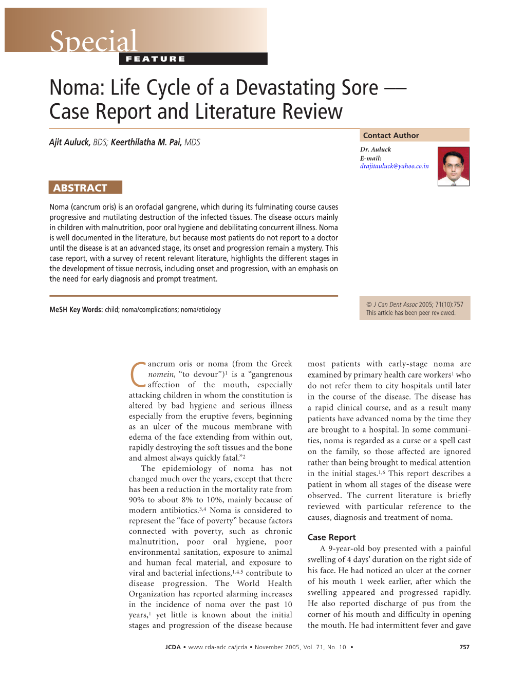 Noma: Life Cycle of a Devastating Sore –– Case Report and Literature Review