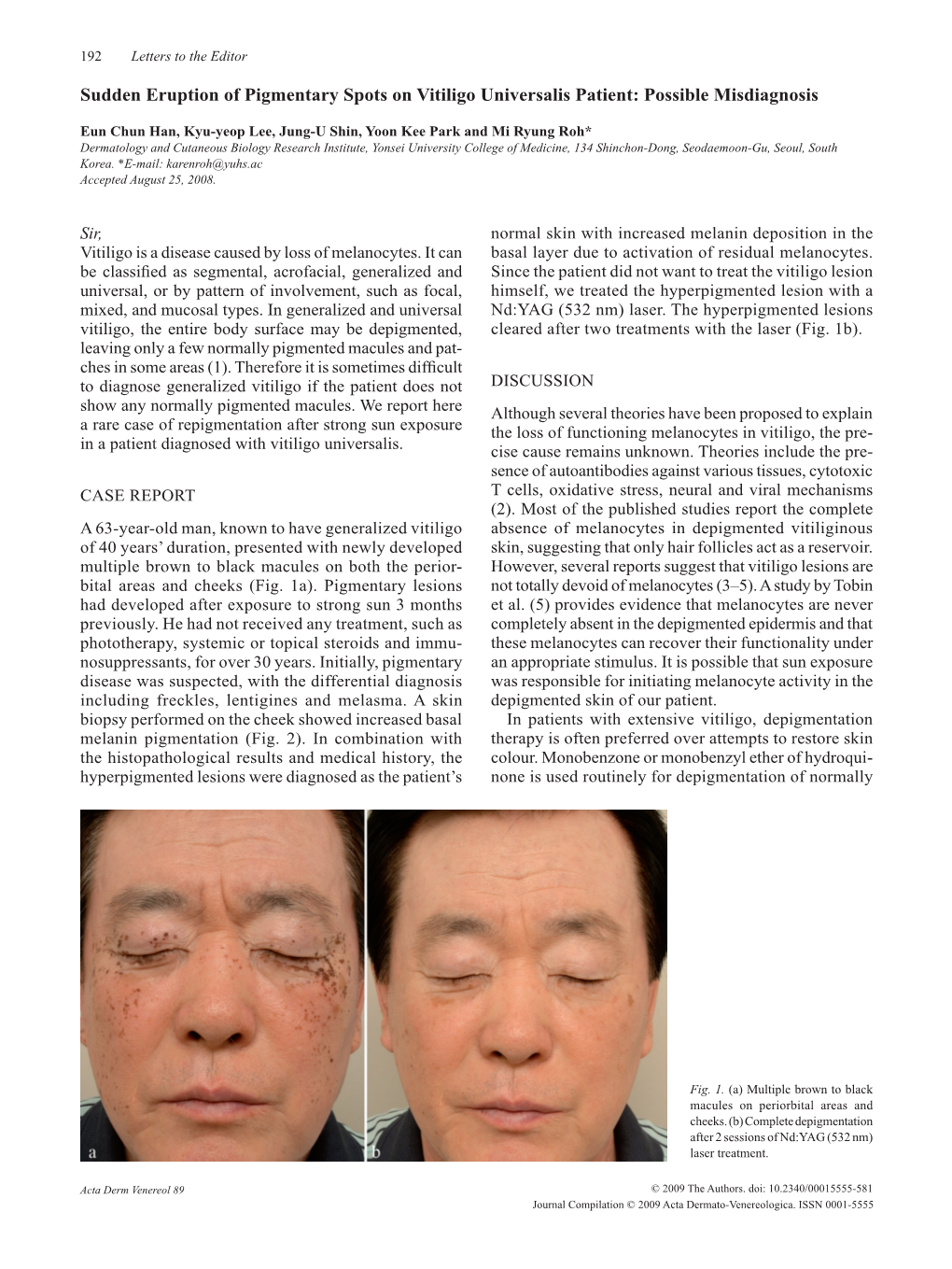 Sudden Eruption of Pigmentary Spots on Vitiligo Universalis Patient: Possible Misdiagnosis