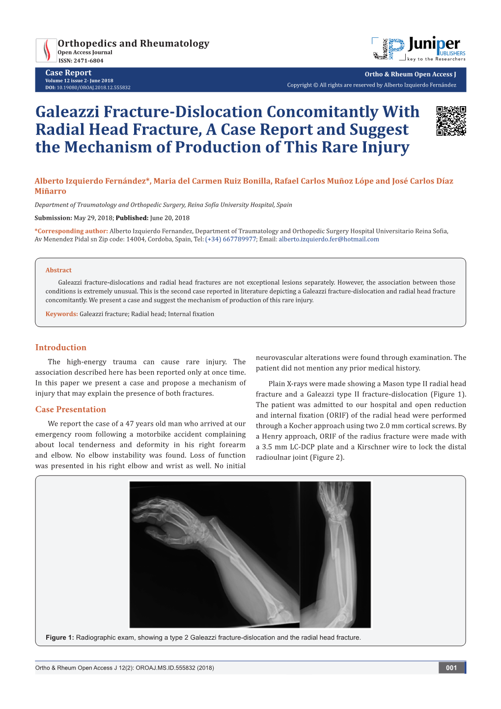 Galeazzi Fracture-Dislocation Concomitantly with Radial Head Fracture, a Case Report and Suggest the Mechanism of Production of This Rare Injury