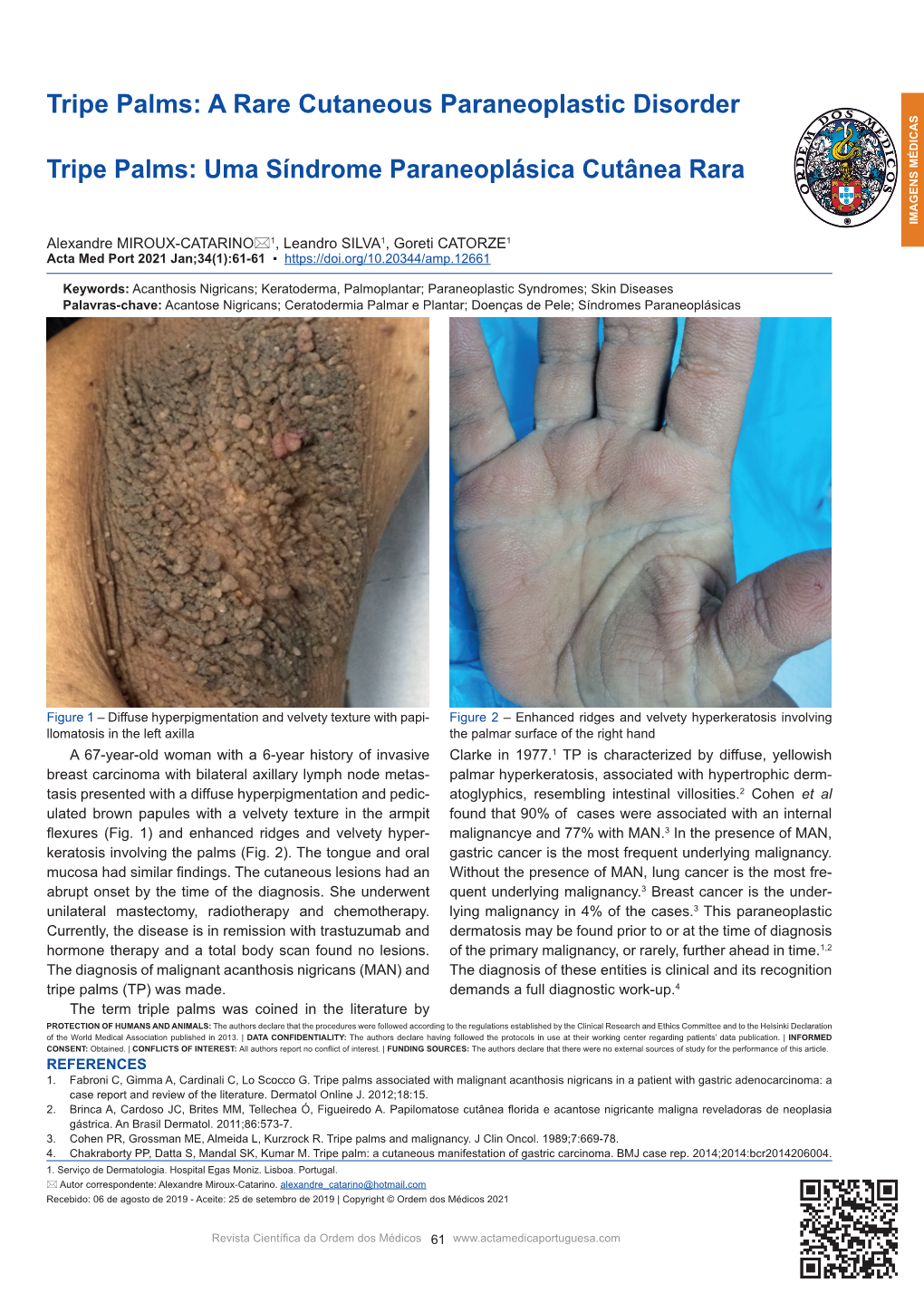 A Rare Cutaneous Paraneoplastic Disorder Tripe Palms