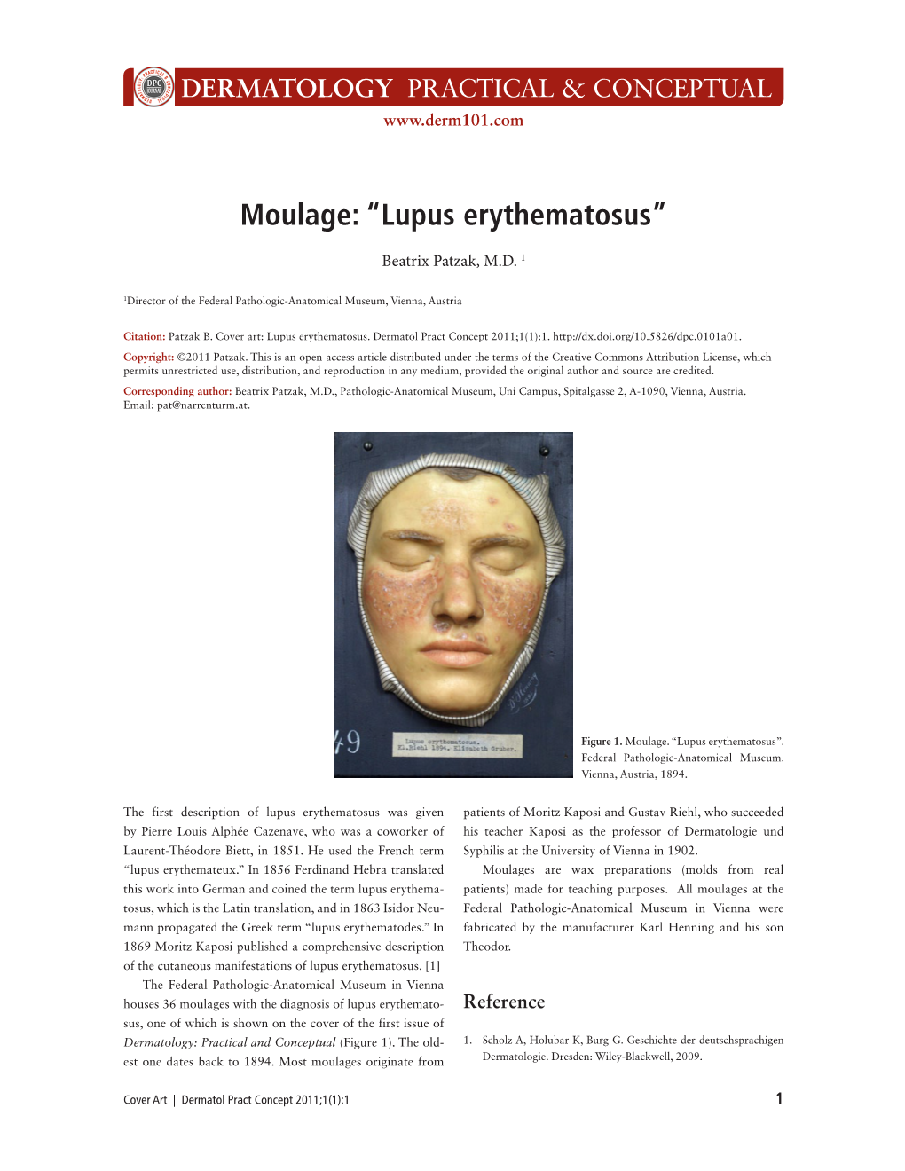 Lupus Erythematosus”