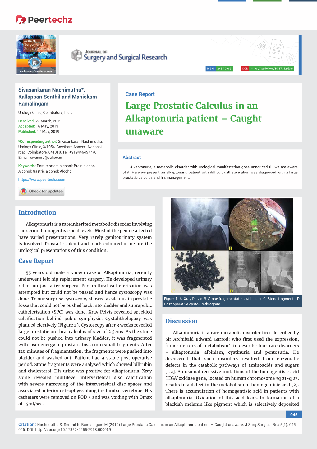 Large Prostatic Calculus in an Alkaptonuria Patient – Caught Unaware