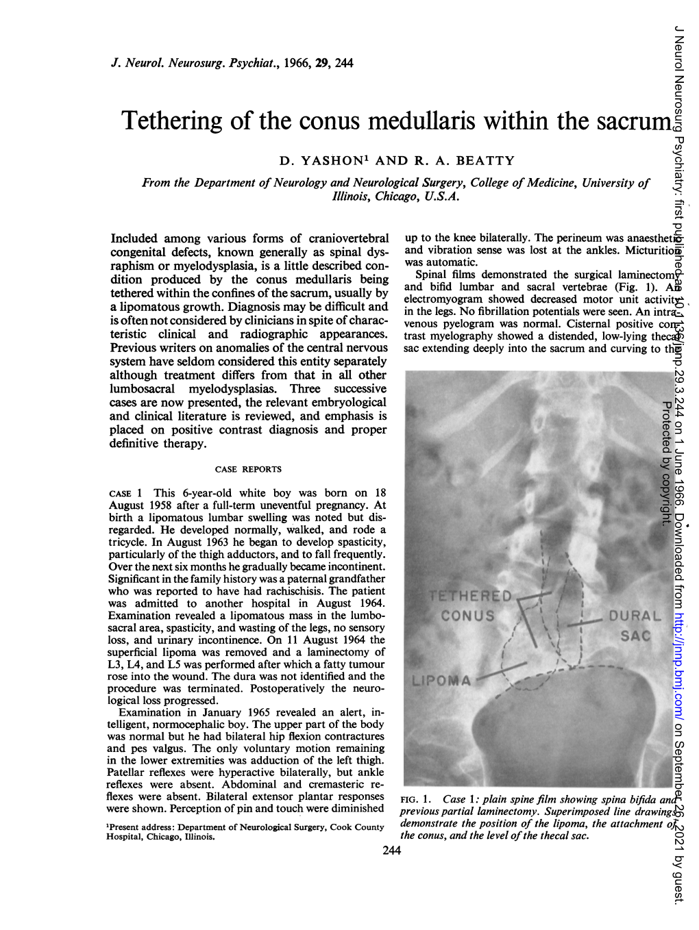 Tethering of the Conus Medullaris Within the Sacrum