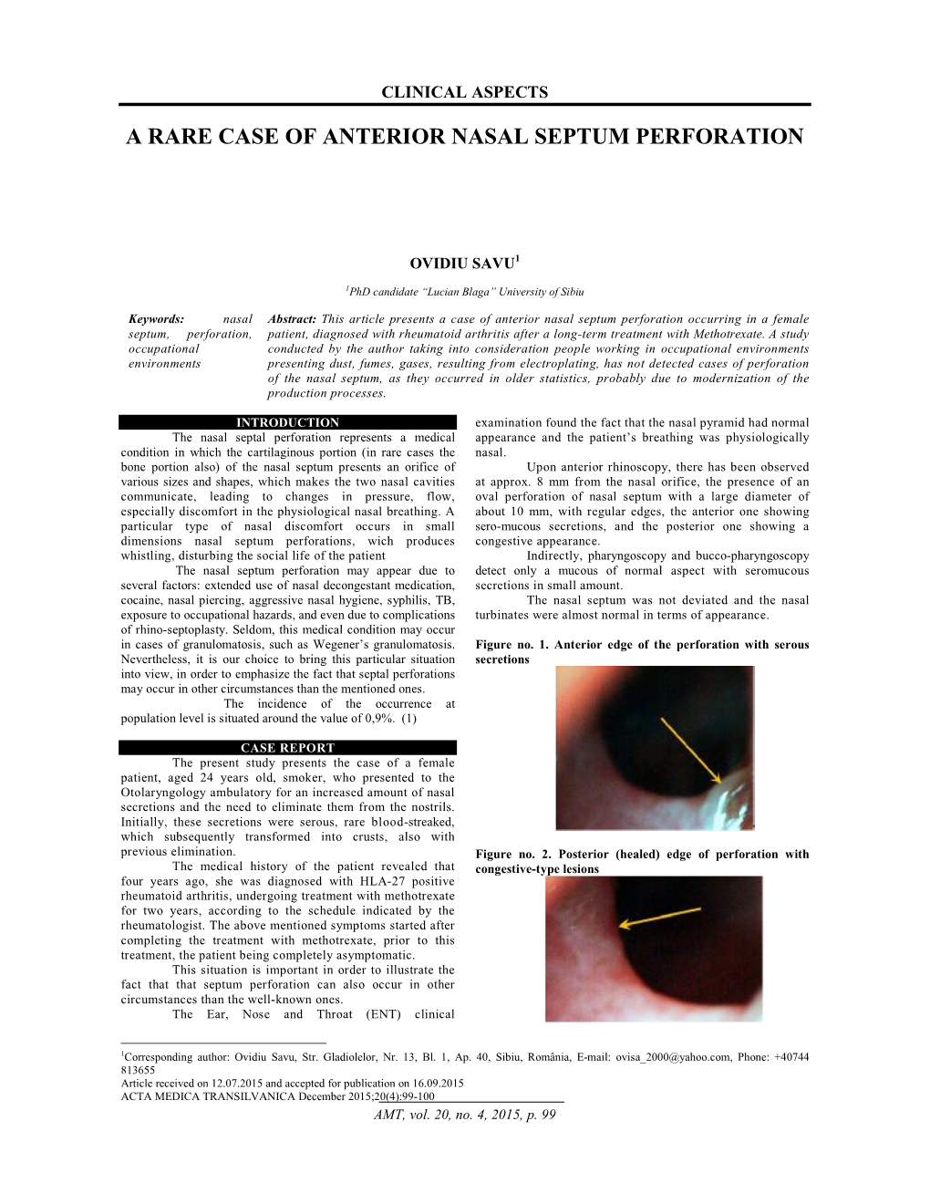 A Rare Case of Anterior Nasal Septum Perforation
