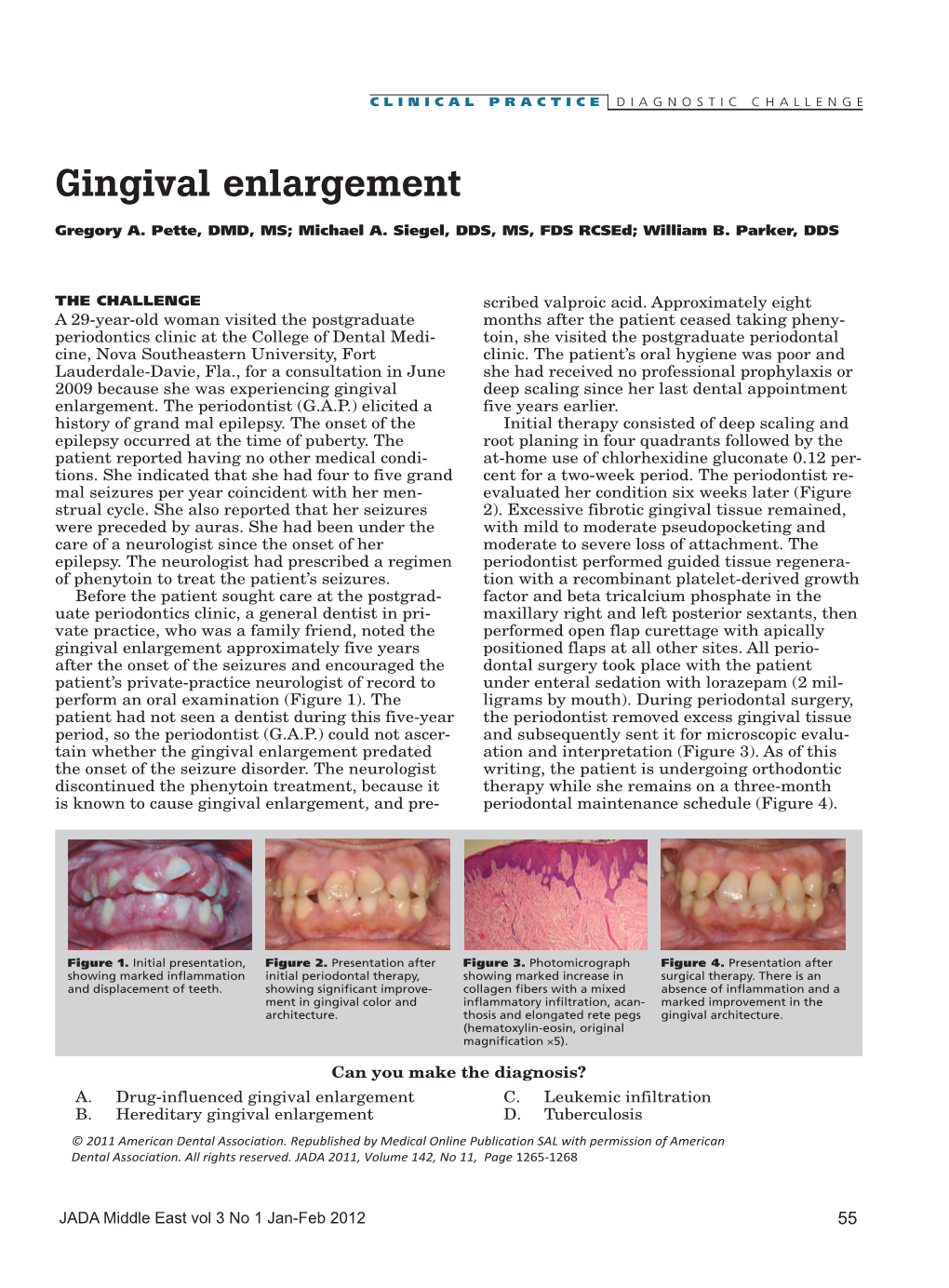 Gingival Enlargement