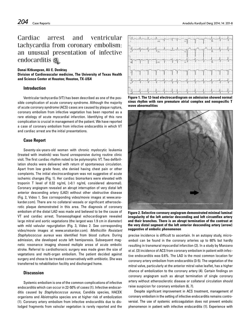 An Unusual Presentation of Infective Endocarditis