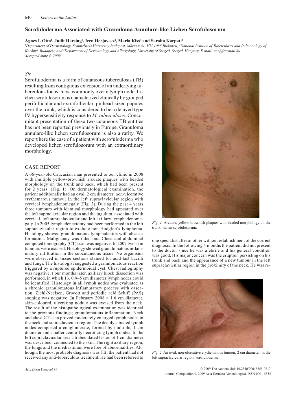 Scrofuloderma Associated with Granuloma Annulare-Like Lichen Scrofulosorum