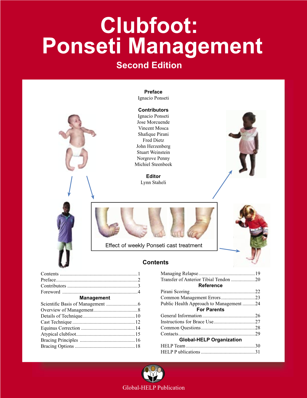 Clubfoot: Ponseti Management Second Edition