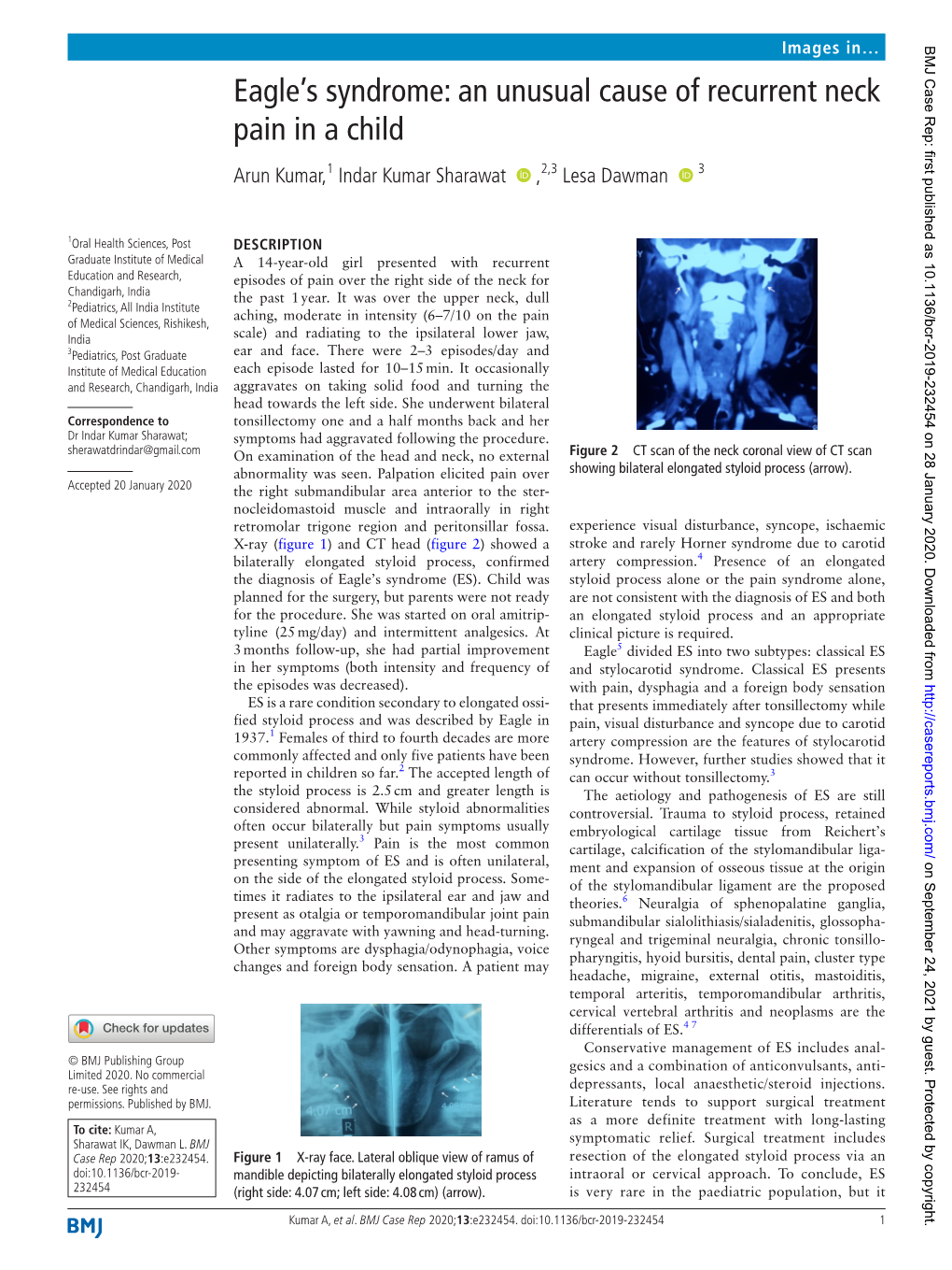 Eagle's Syndrome: an Unusual Cause of Recurrent Neck Pain in a Child