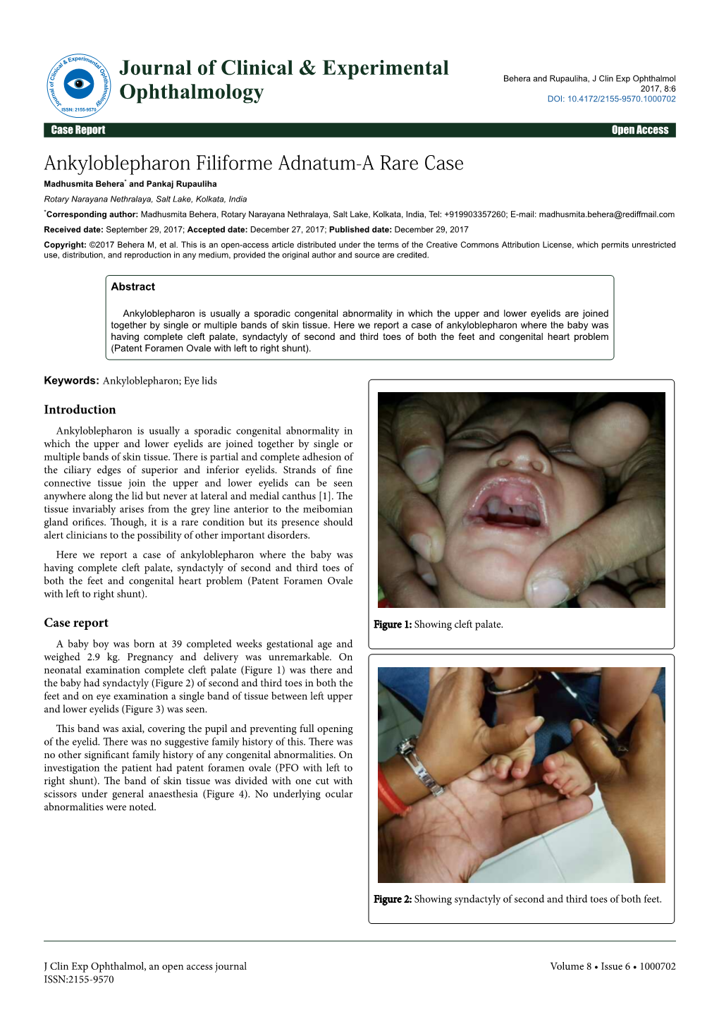 Ankyloblepharon Filiforme Adnatum-A Rare Case