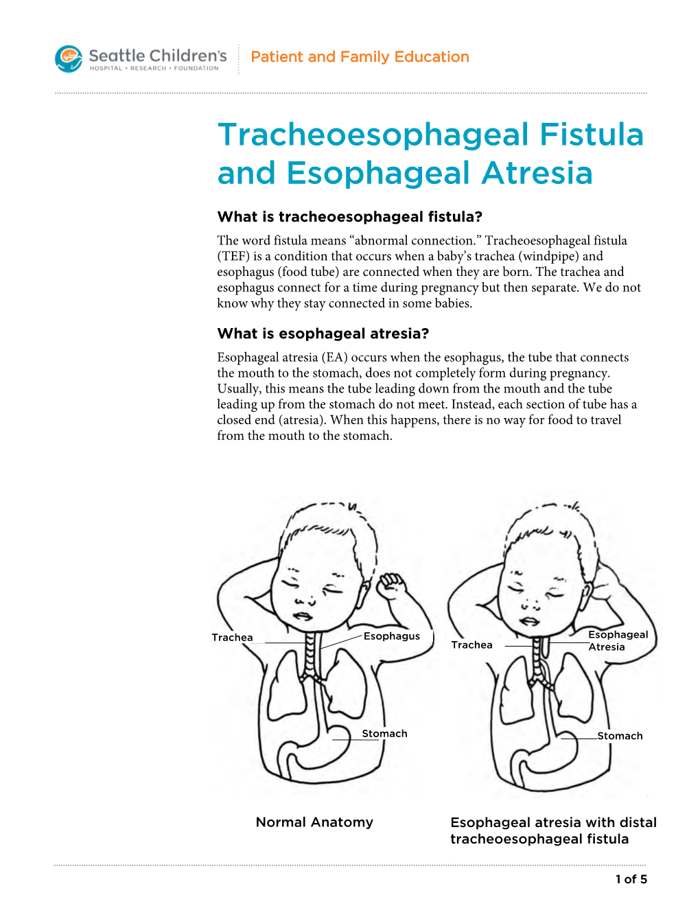 PE316 Tracheoesophageal Fistula and Esophageal Atresia