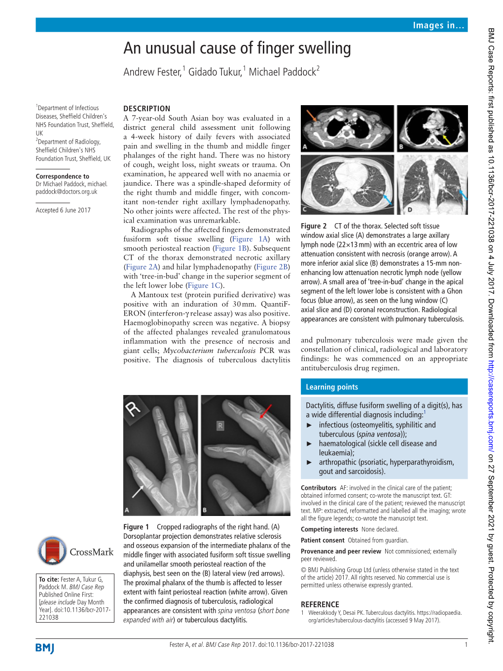 An Unusual Cause of Finger Swelling Andrew Fester,1 Gidado Tukur,1 Michael Paddock2