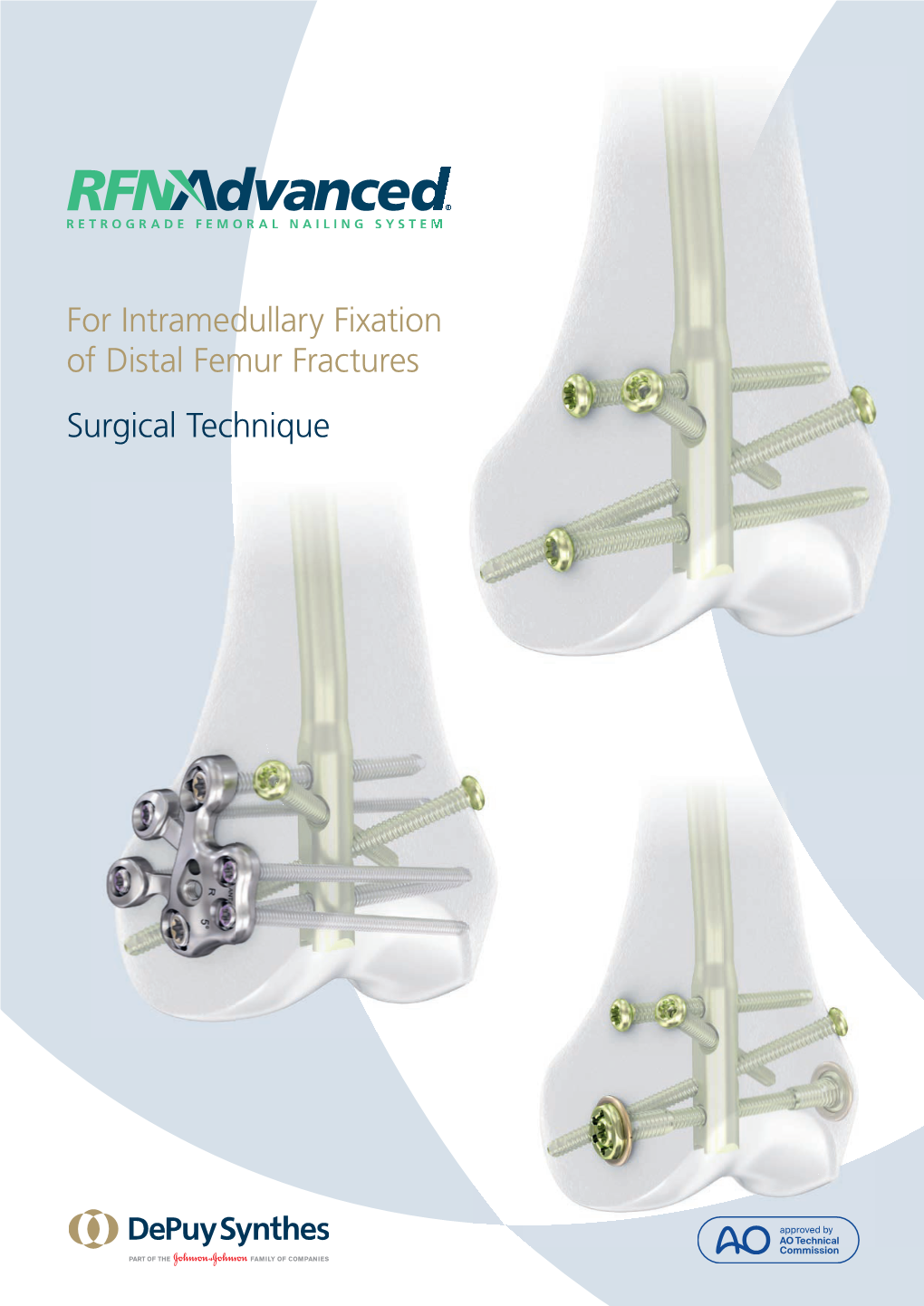 For Intramedullary Fixation of Distal Femur Fractures Surgical Technique Image Intensiﬁer Control
