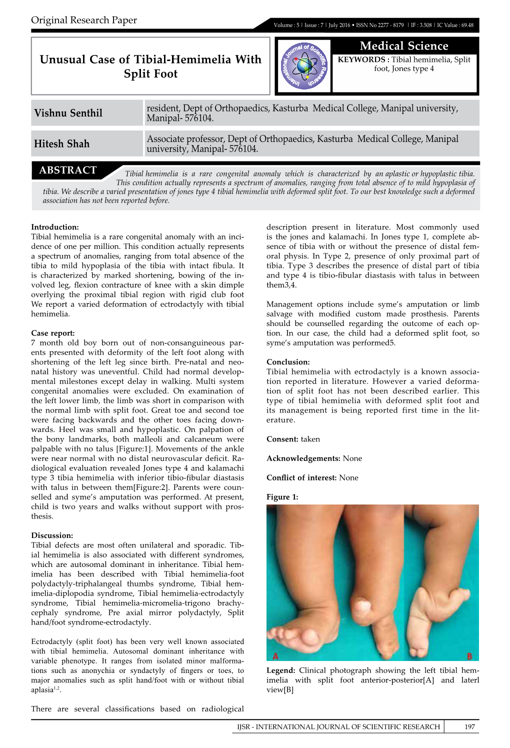 Medical Science Unusual Case of Tibial-Hemimelia with Split Foot