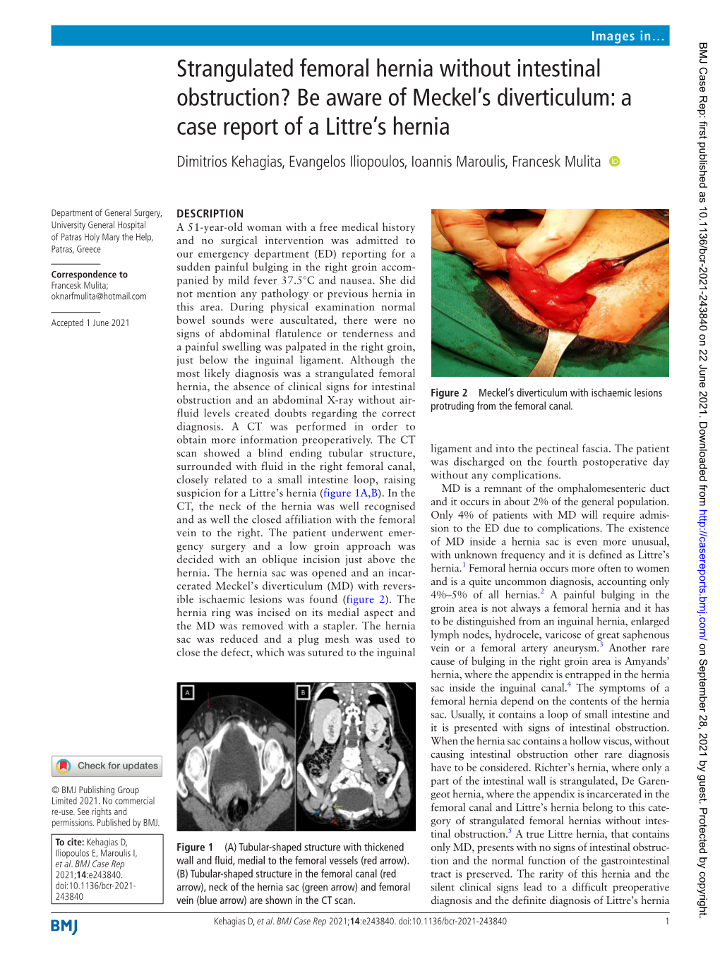 Strangulated Femoral Hernia Without Intestinal Obstruction?