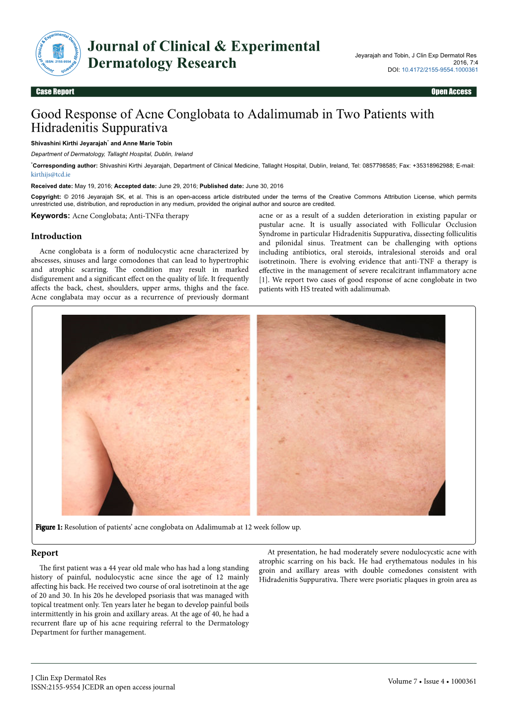 Good Response of Acne Conglobata to Adalimumab in Two Patients With