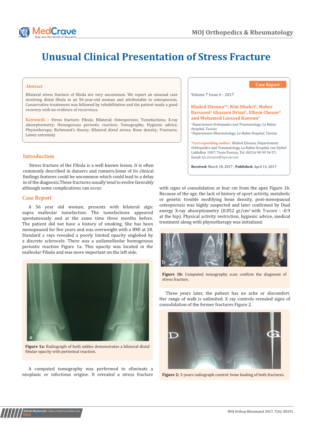 Unusual Clinical Presentation of Stress Fracture