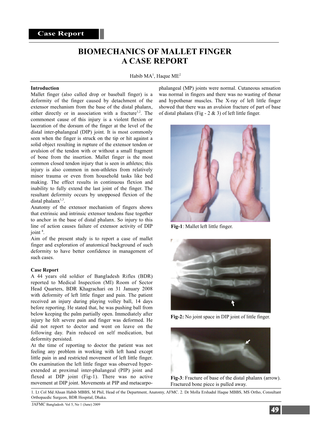 Biomechanics of Mallet Finger a Case Report