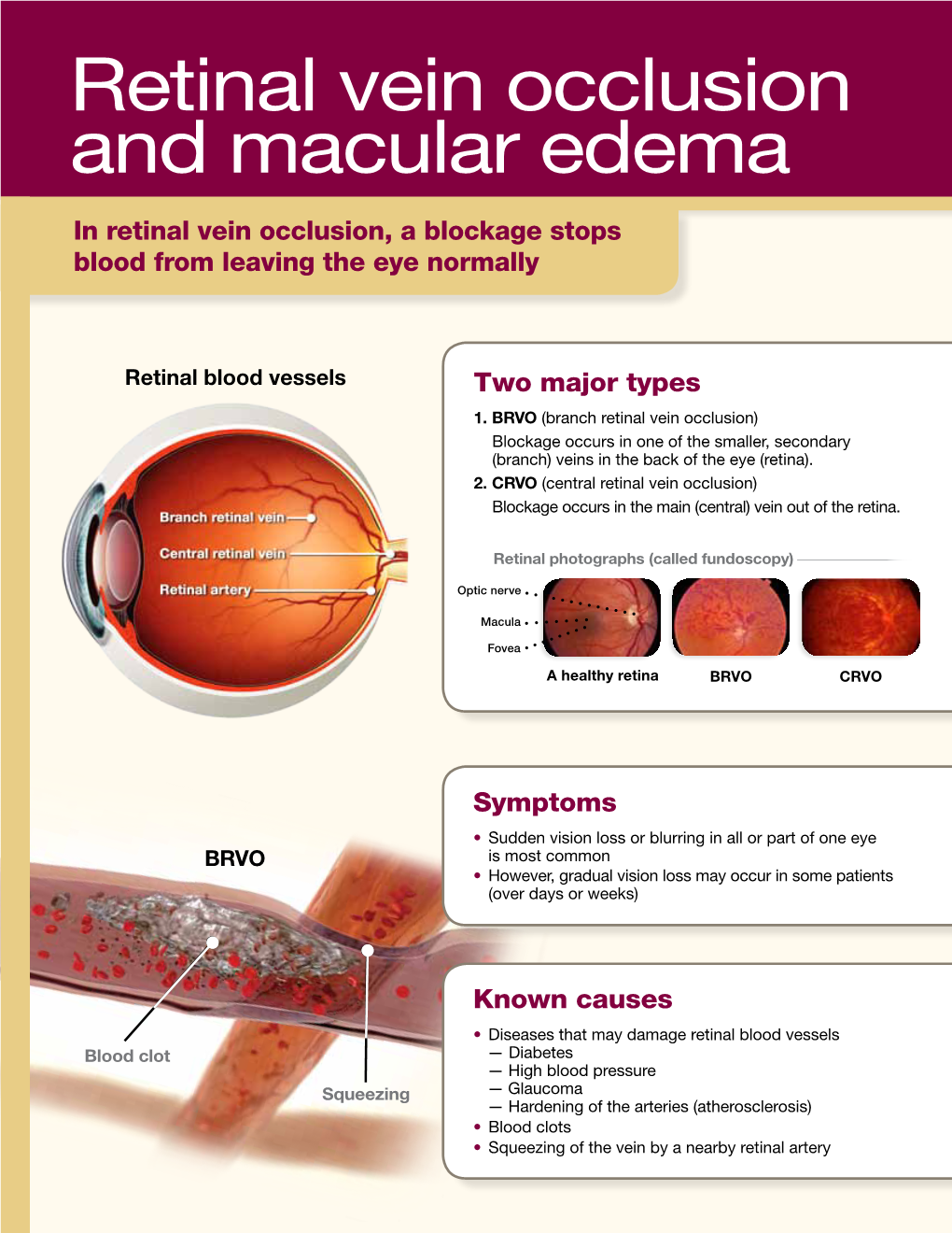 Retinal Vein Occlusion and Macular Edema