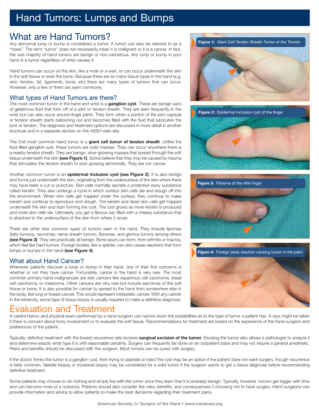 Hand Tumors: Lumps and Bumps What Are Hand Tumors? Any Abnormal Lump Or Bump Is Considered a Tumor