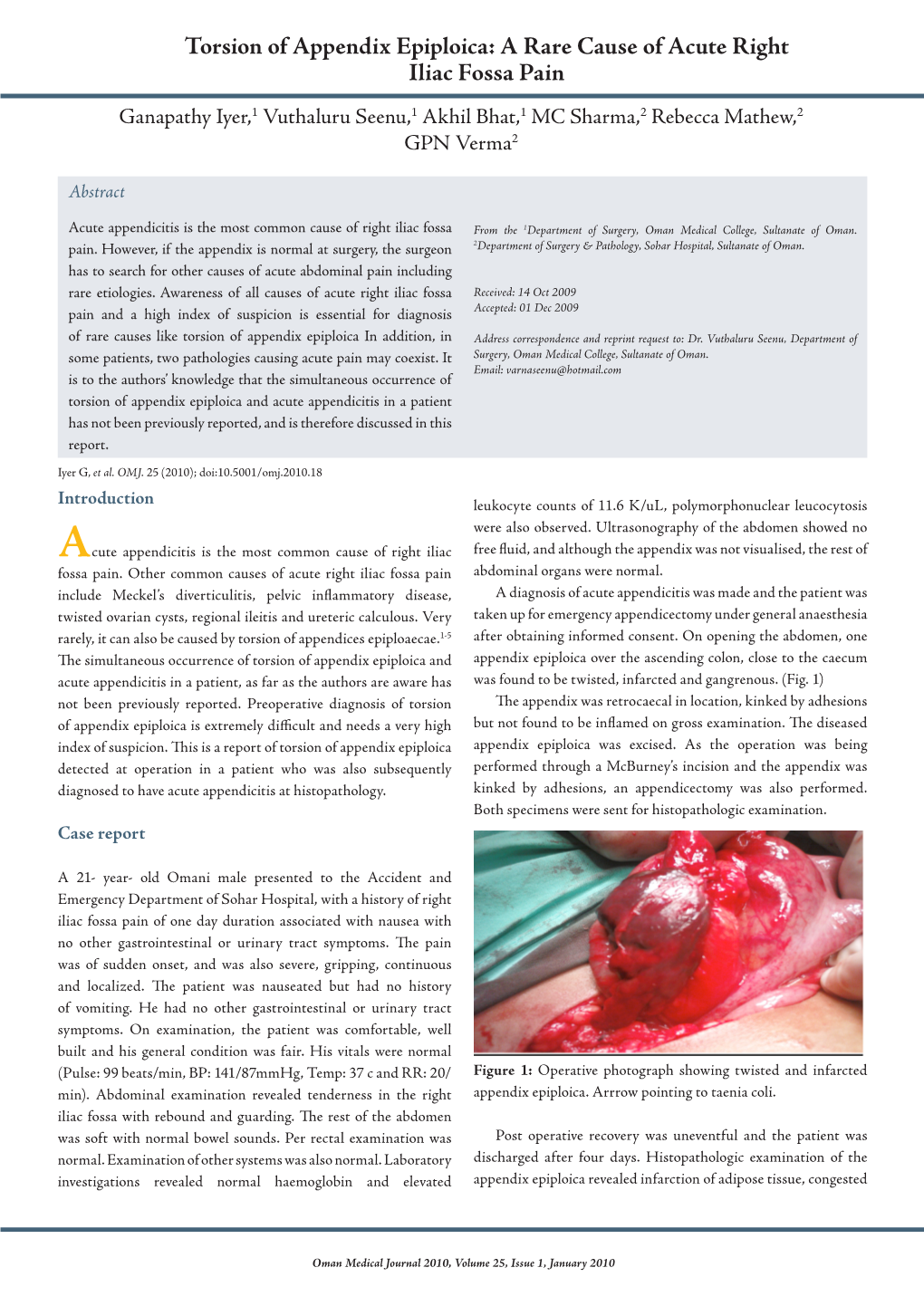 Torsion of Appendix Epiploica: a Rare Cause of Acute Right Iliac Fossa Pain Ganapathy Iyer,1 Vuthaluru Seenu,1 Akhil Bhat,1 MC Sharma,2 Rebecca Mathew,2 GPN Verma2