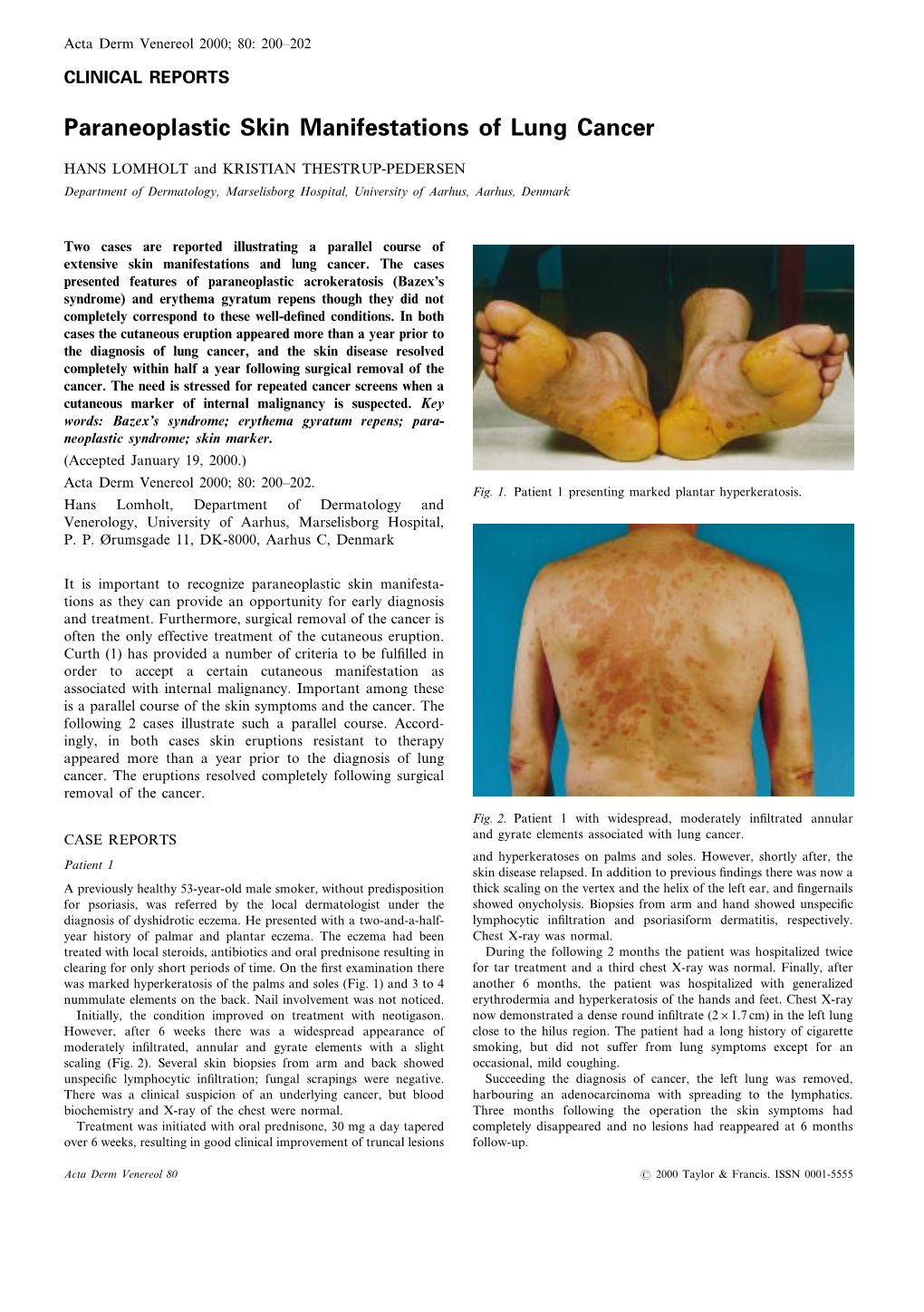 Paraneoplastic Skin Manifestations of Lung Cancer